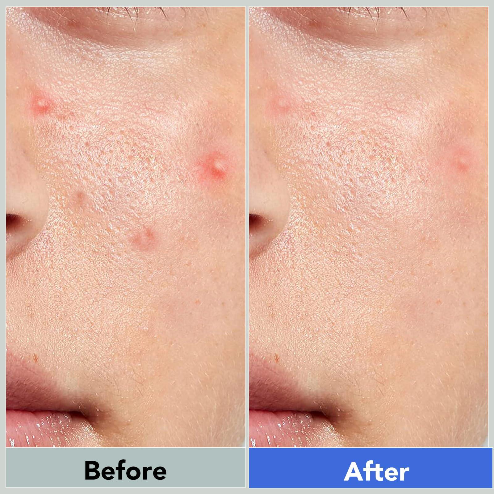 Qmakup Qmakup Pimple Patches for Face,Acne Patches for Face,Pimple Patch,Zit Patches,Hydrocolloid Blemish Patches for Covering Zits and Blemishes,with Salicylic Acid,Tea Tree oil & Calendula oil, 108 Counts