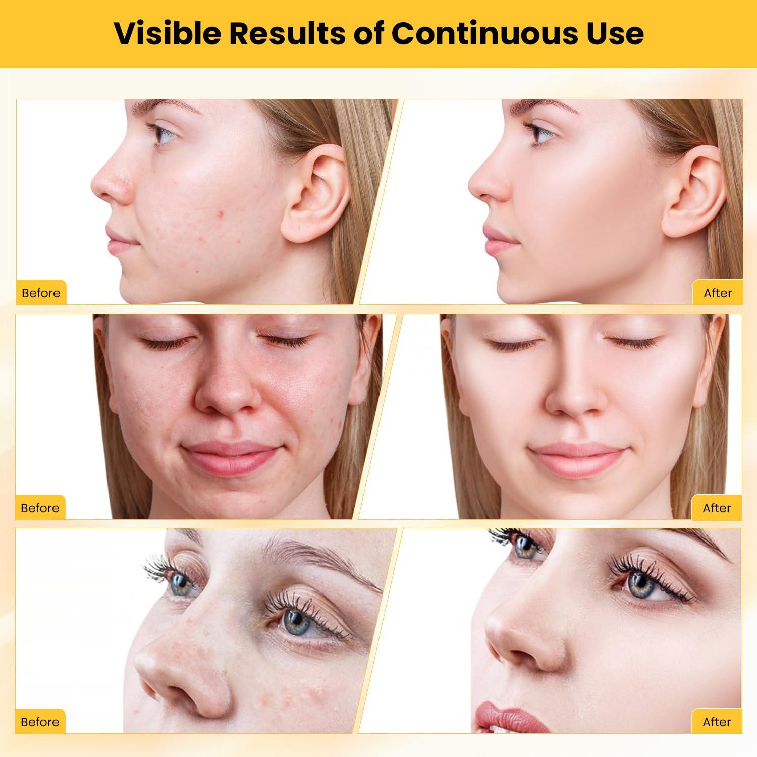 UNOISETION UNOISETION Microdermabrasion Machine and Diamond Tips Kit