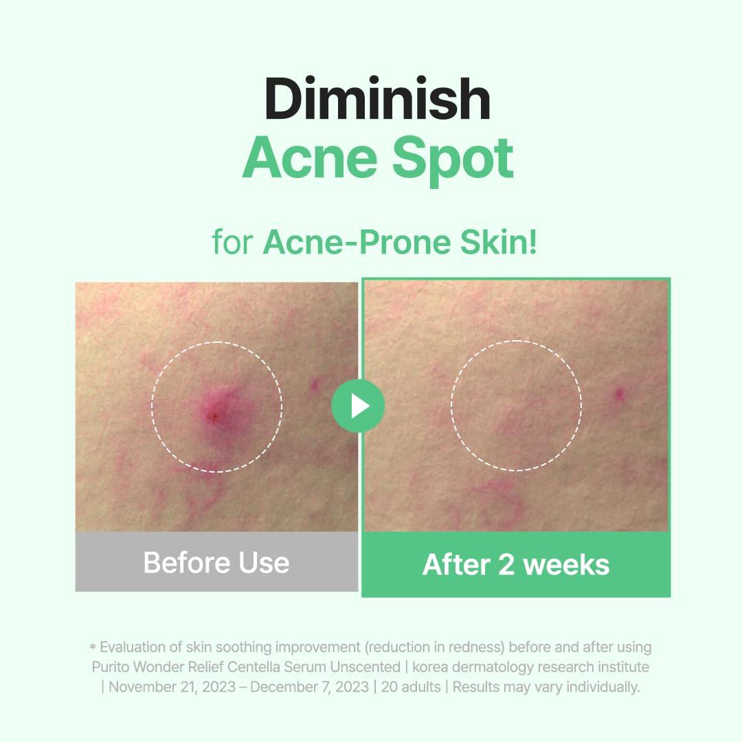 PURITO PURITO Centella Unscented Serum, Korean Centella, for All Skin Types, Ampoule, Soothing, Calming, Facial Serum for face, Vegan & Cruelty-Free, Korean Skin Care, 60ml 2fl.oz