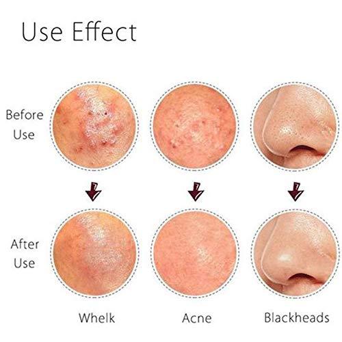 FEITA Blackhead Remover Kit - FEITA Blackhead Tweezers Removal Tool Kit Set - Acne Tweezers Pimple Comedone Extractor With Travel Case (5 Pcs)