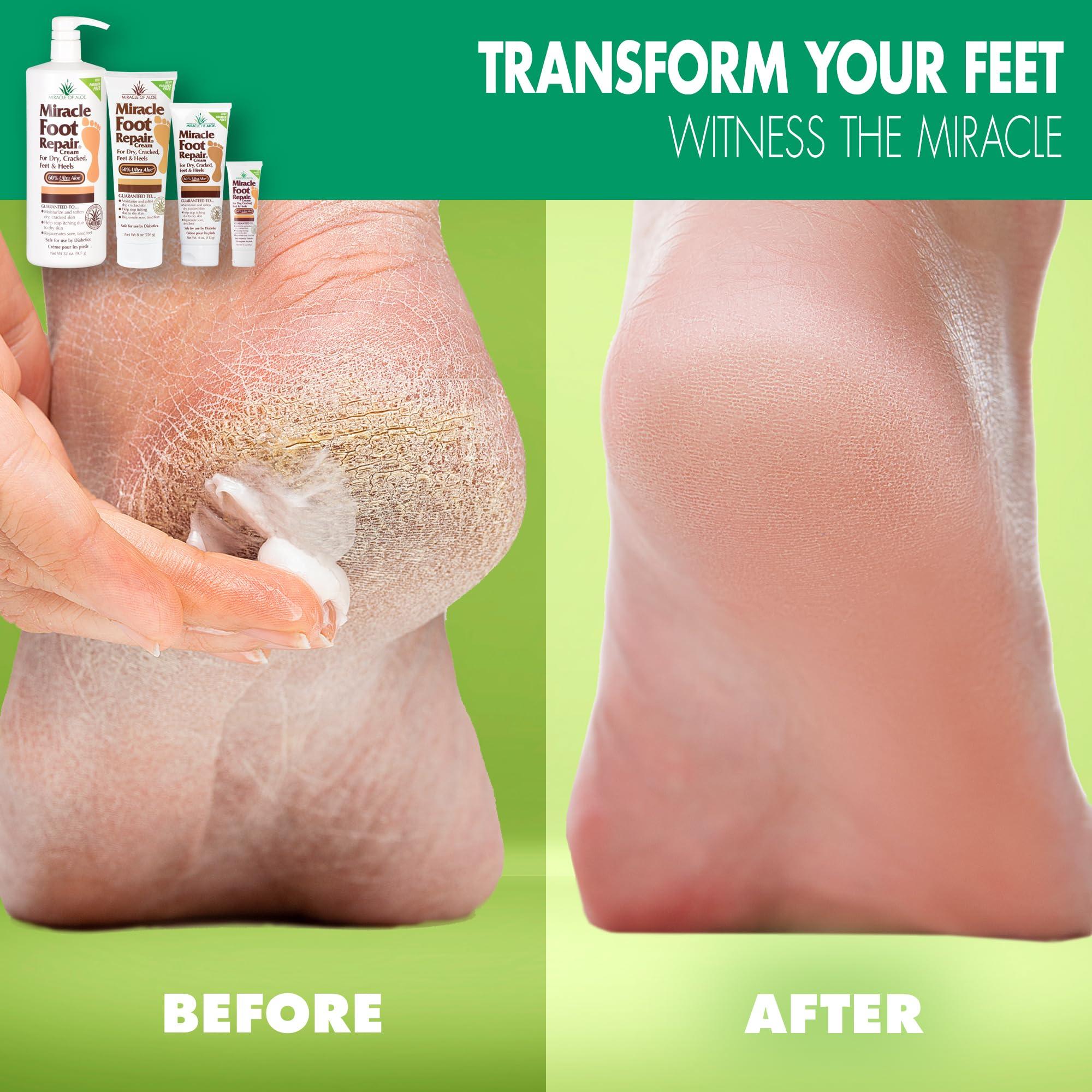 Miracle of Aloe Miracle Foot Repair Cream (8 oz / 2-Pack) Repairs Dry Cracked Heels and Feet, 60% Pure UltraAloe Moisturizes, Softens, and Repairs