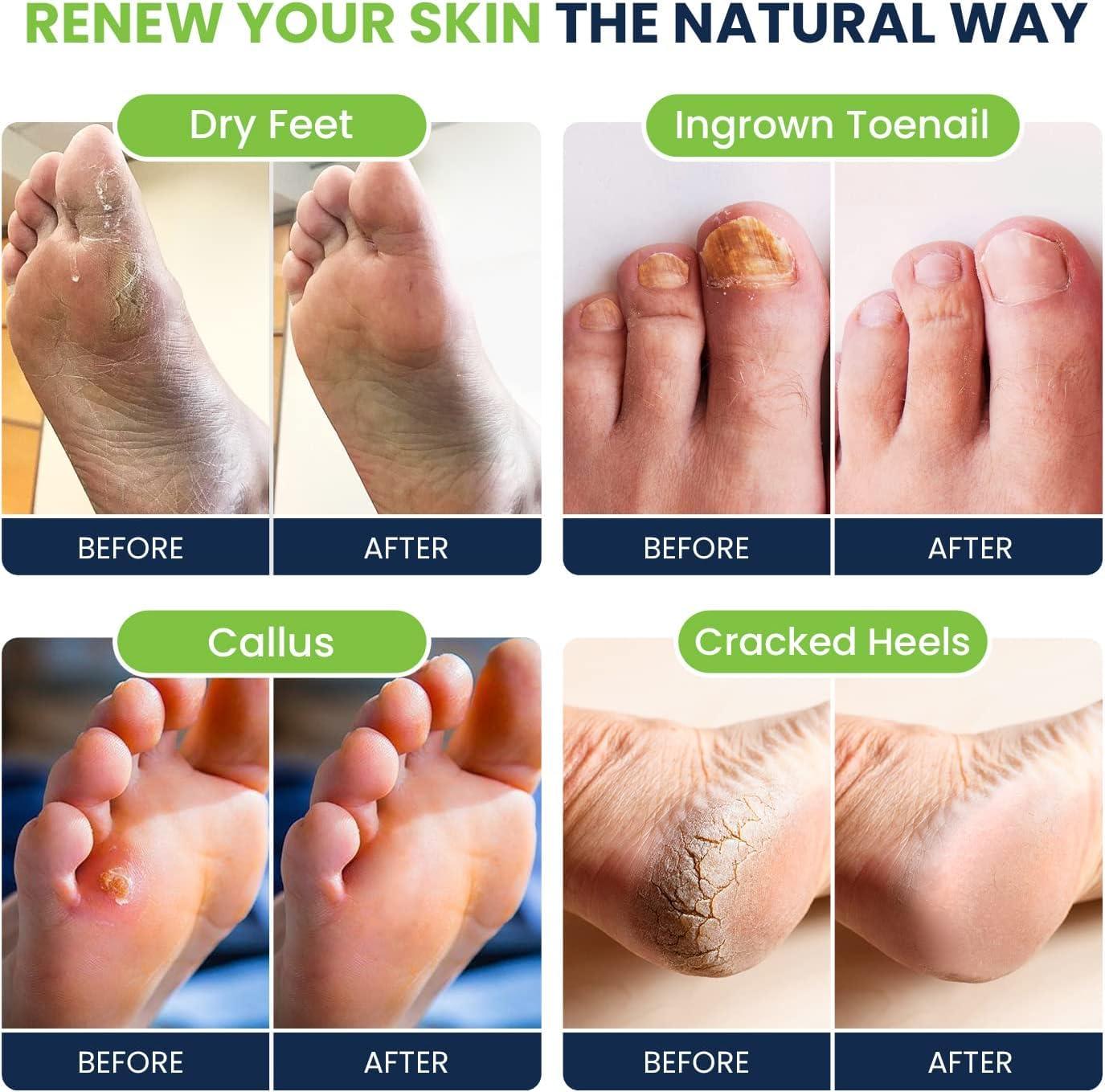 FOOT CURE Tea Tree Oil & Soothing Lavender Foot Soak with Epsom Salt Callus Remover for Feet with Extra Strength Gel & Foot Pumice Stone Set