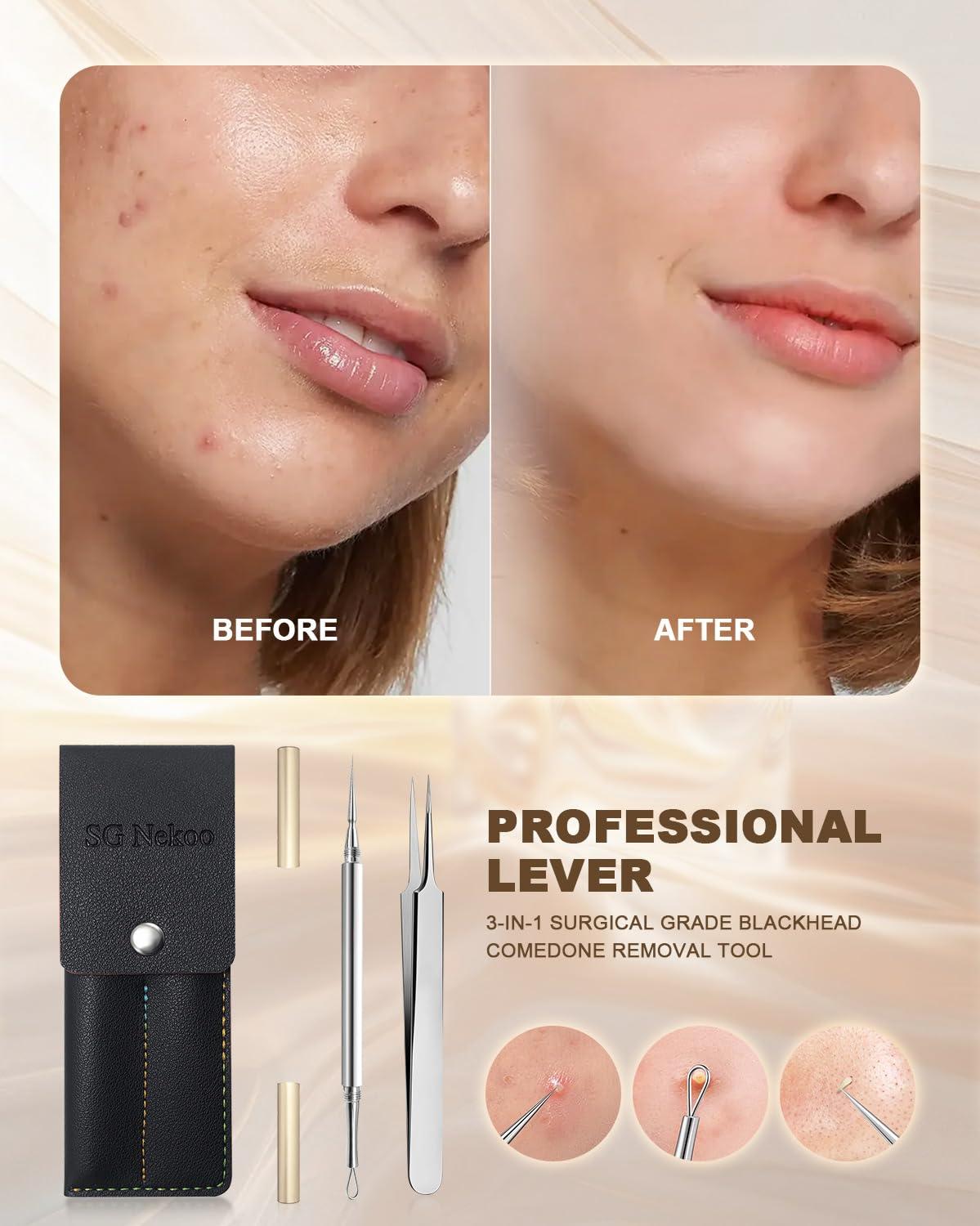 SG Nekoo SGNEKOO Professional Facial Milia Removal Tool and Whitehead Extractor,Titanium Alloy Double Ended Needle and Steel Tweezers Kit,Blackhead,Blemish,Zit and Pimple Acne Remover Popper (Titanium Gold)