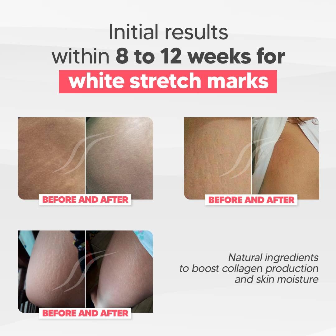 Cicatrissim Cicatrissim White Stretch Mark Fade and Removal Cream - Innovative Formula With Pure and Powerful Natural Ingredients From Brazilian Flora - For All Skin Types.