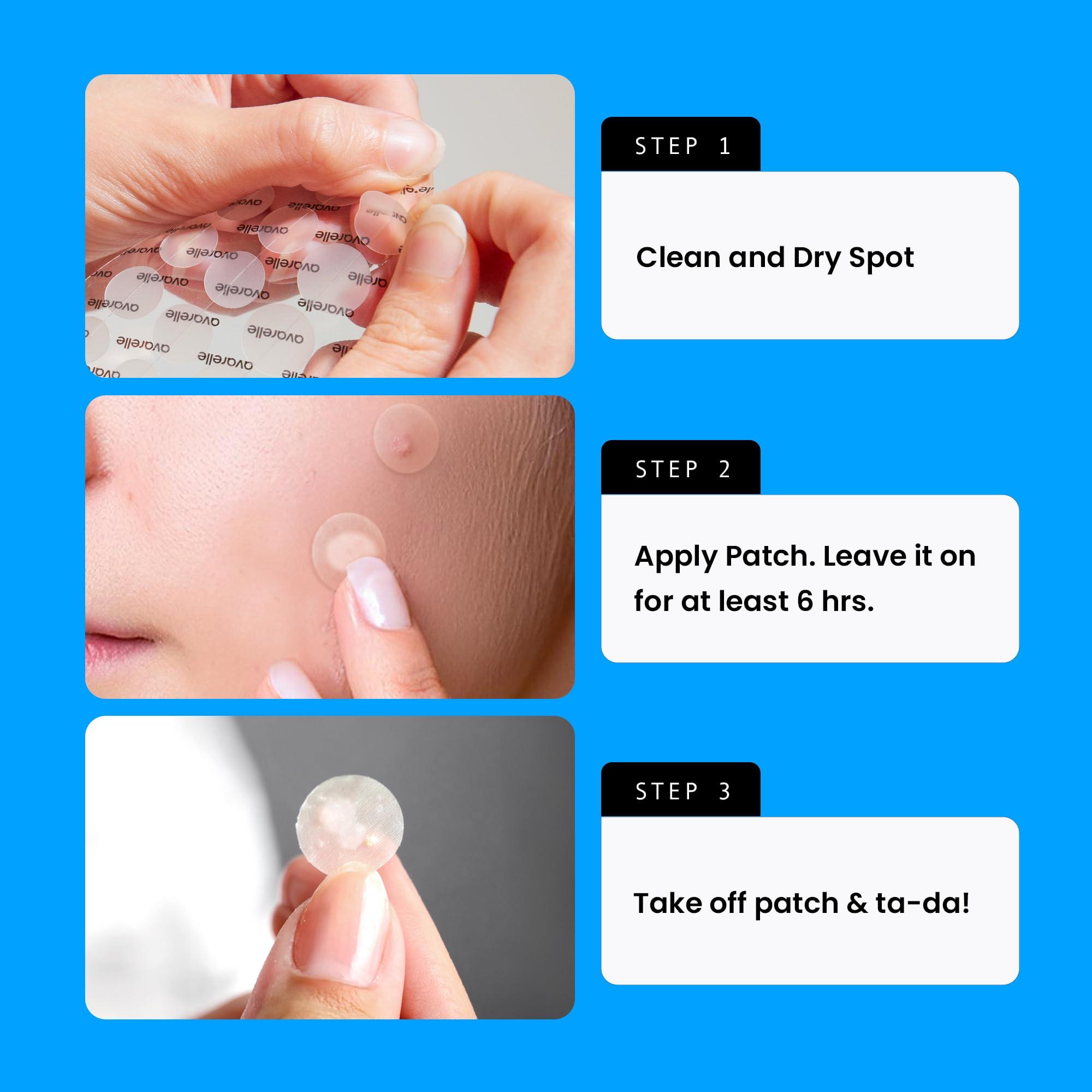 AVARELLE AVARELLE Acne Cover Patches, FSA HSA Eligible Hydrocolloid Pimple Patches for Face with Tea Tree Oil, Korean Skincare Zit Patches for Face | FSA HSA Store Eligible Items | Vegan, Cruelty-free