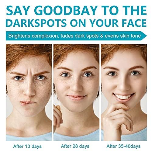 SWETIYOU Dark Spot Remover for Face, Fast-Acting Dark Spot Corrector Remover for Face and body Hyperpigmentation, Fades Melasma, Freckle, Sun Spots, Evens Skin Tone, Age Spot Remover for Women Men
