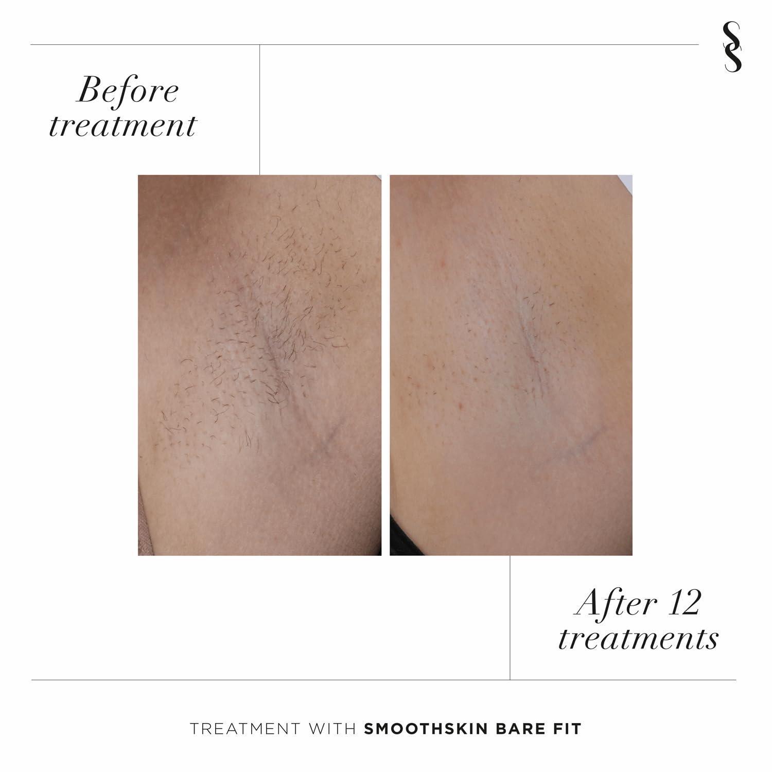 SMOOTHSKIN SmoothSkin Bare Fit IPL long-lasting body and facial hair removal device for women & men - alternative to laser hair removal. With precision head.