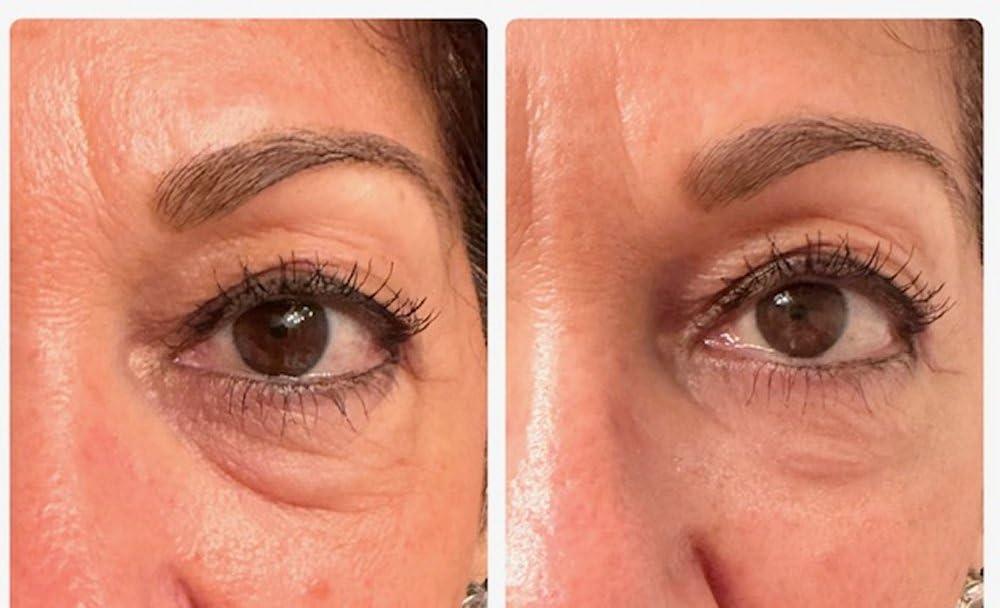 Generic Instant Eye Bag Puffiness And Wrinkle Remover Cream For Women And Men Made In The USA! Cruelty-Free