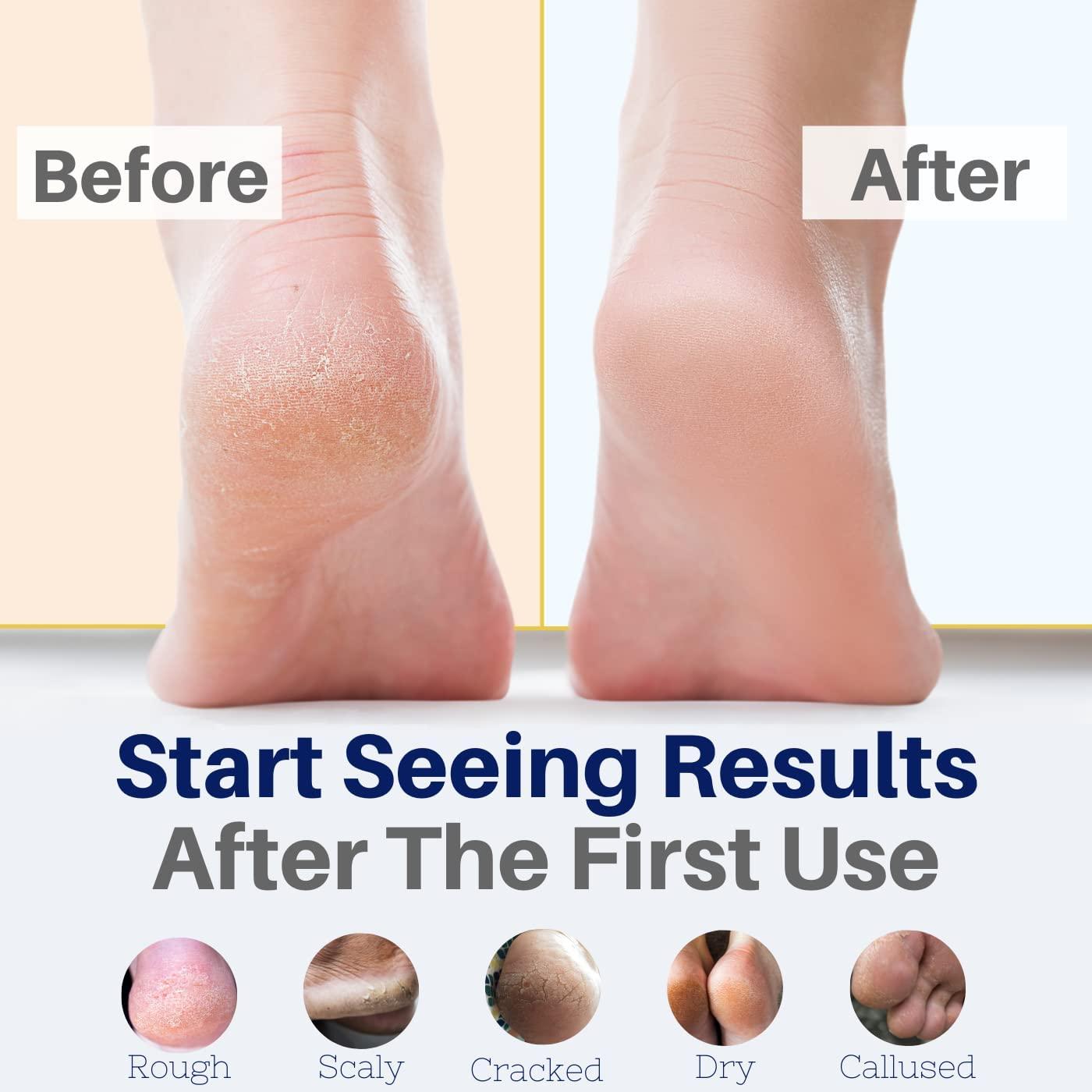 NC NATURAL CURES Tea Tree Oil Foot Balm - Instantly Hydrates Cracked Dry Feet and Callused Heels - All Natural Treatment Helps & Soothes Irritated Skin & Athletes Foot, Best Moisturizing Foot Care For Woman & Man - Made in USA