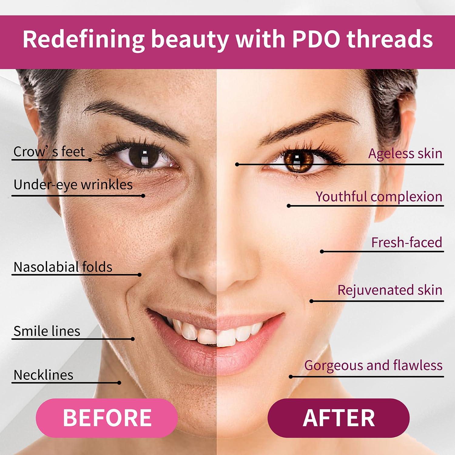 elves Elves 4D COG PDO Threads for Face Whole Body Lift B19G-100 / PDO Cog Threads Bidirectional Blunt-Type for Face Lift/10pcs