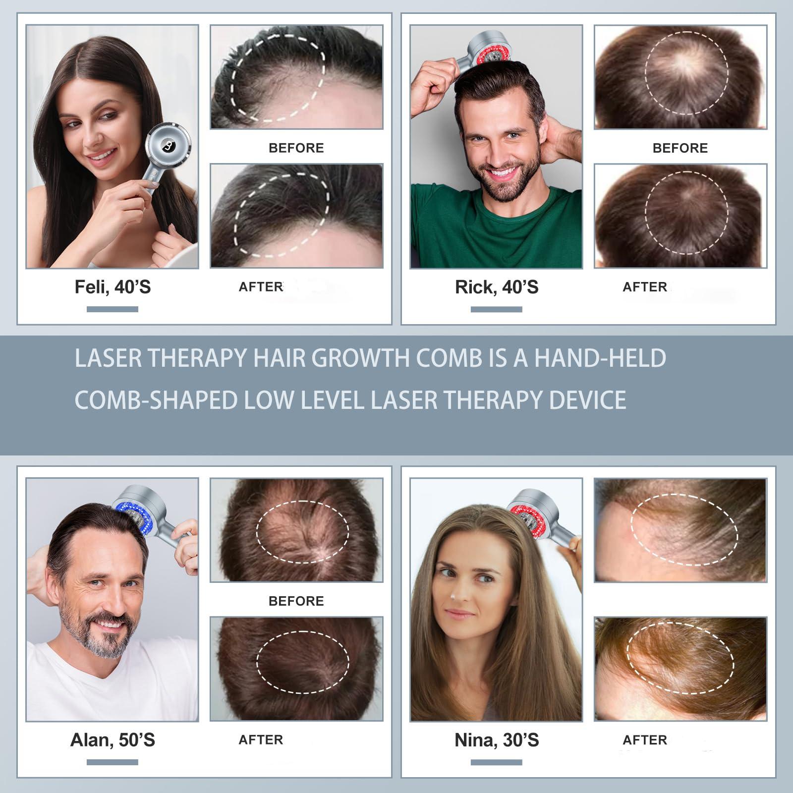 HAUBAT Laser Therapy Comb - FDA Cleared Hair Loss Treatment for Thinning Hair in Men & Women