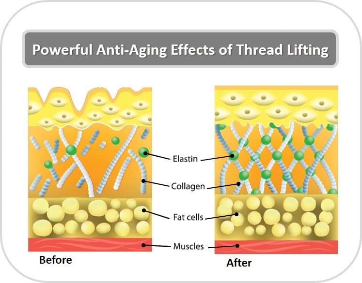 CRD Eye Care - ACE PDO thread lift KOREA - Mono Type/Blunt 30G25 (20pcs) for Eye Care (30G25/35)