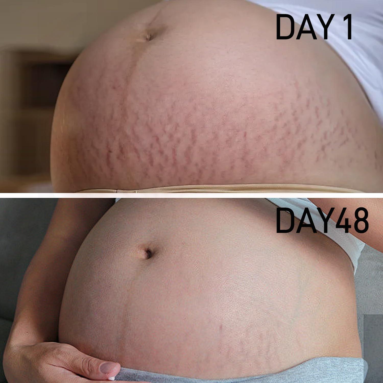 AOAO PEGO Stretch Marks Oil Maternity Body Oil for Stretch Marks Pregnancy Skin Care oil, Prevention & Reduction of Stretch Marks Pregnancy, 4.06 oz (2pcs)