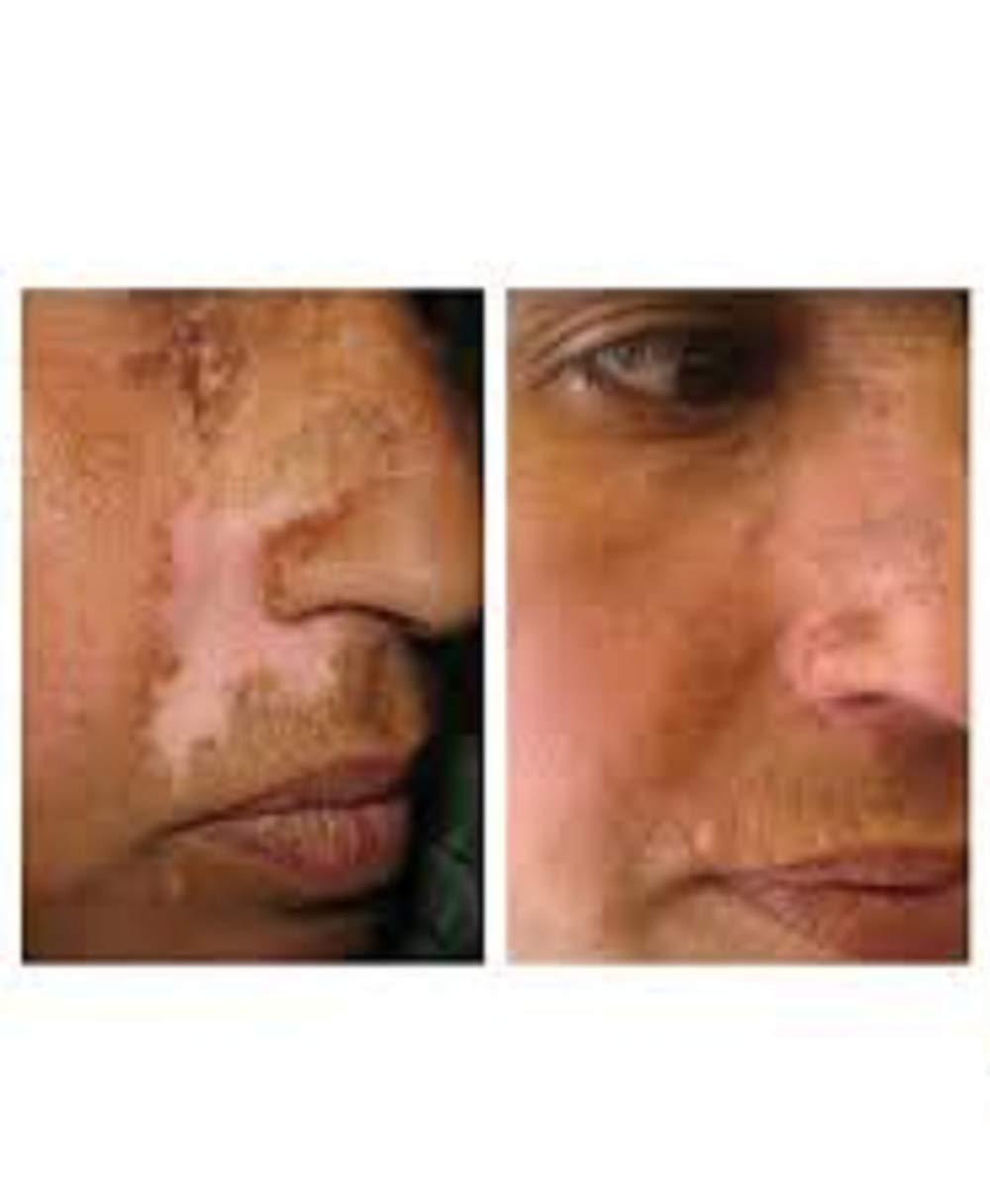 Fiico Melgain Lotion for Vitiligo/White Patches: Decapeptide : Stimulates Pigmentation 10ml (Pack OF 2) - With Express Shipping