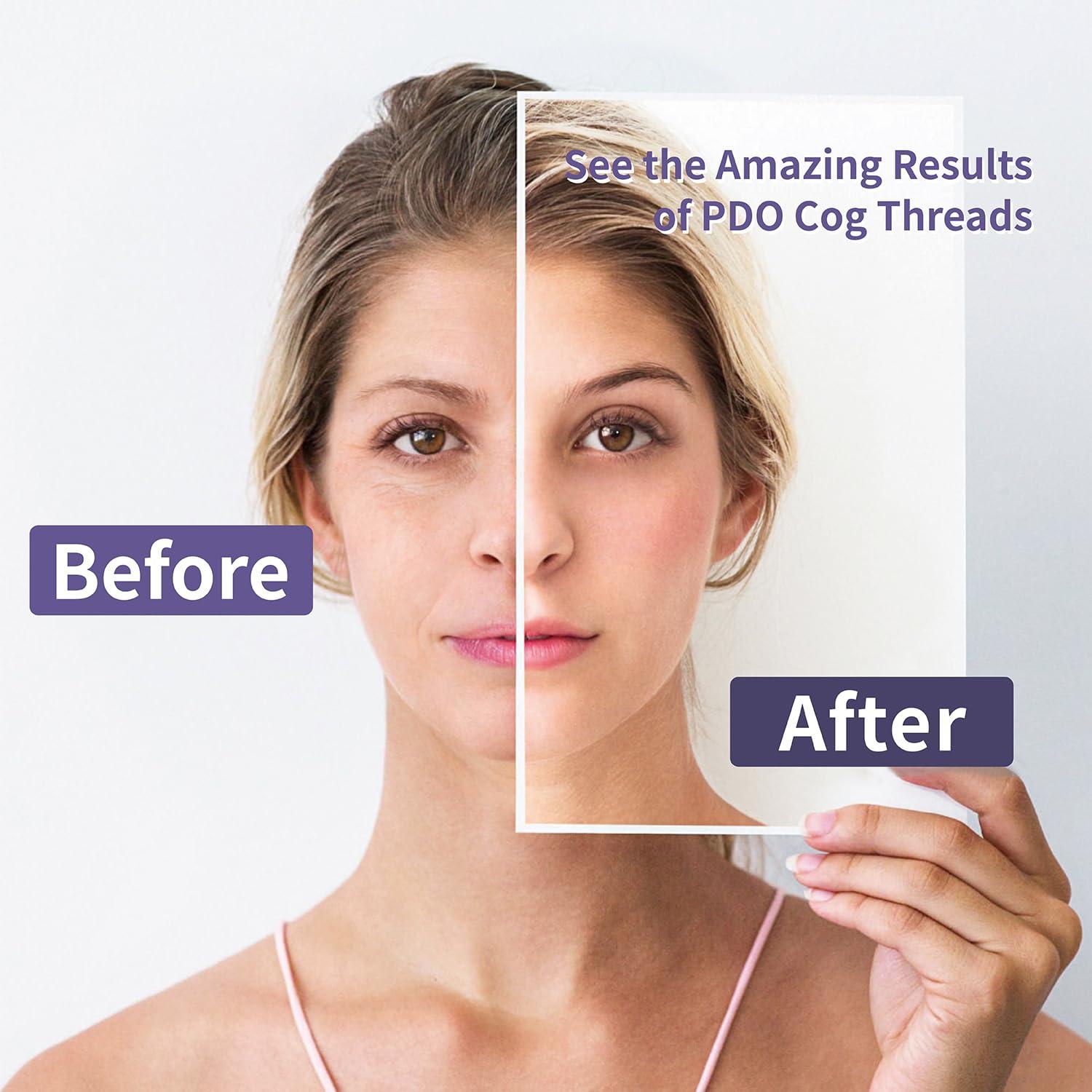 elves elves Pdo Threads for Face Lift (4D Cog Threads 21G 100MM)/ Barbed Pdo COG Threads 360R Bidirection/L-Blunt Type (20pcs)