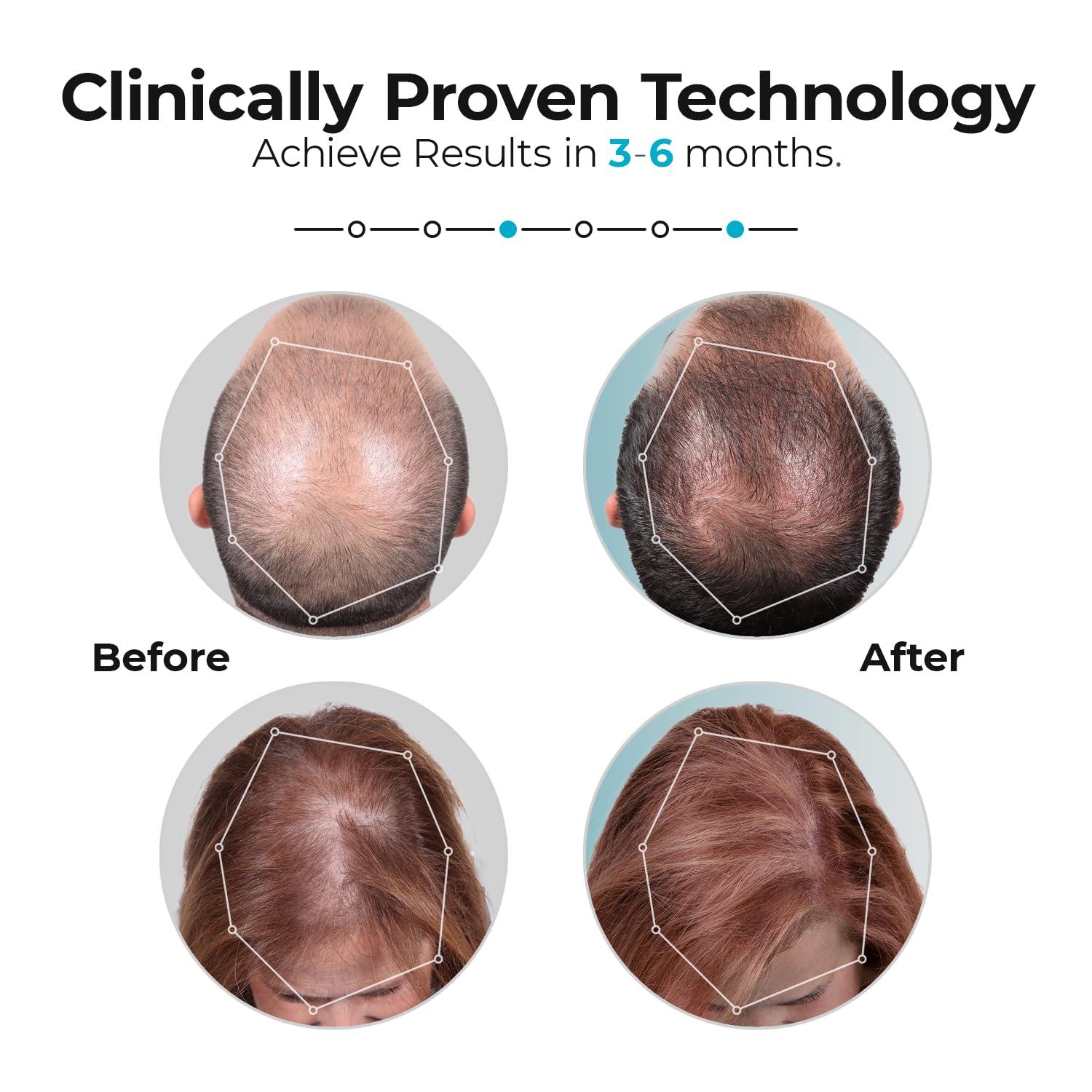 Capillus Capillus Pro Mobile Laser Therapy Cap for Hair Regrowth, with 272 Red Light Lasers for Laser Hair Growth, Red Light Hair Growth