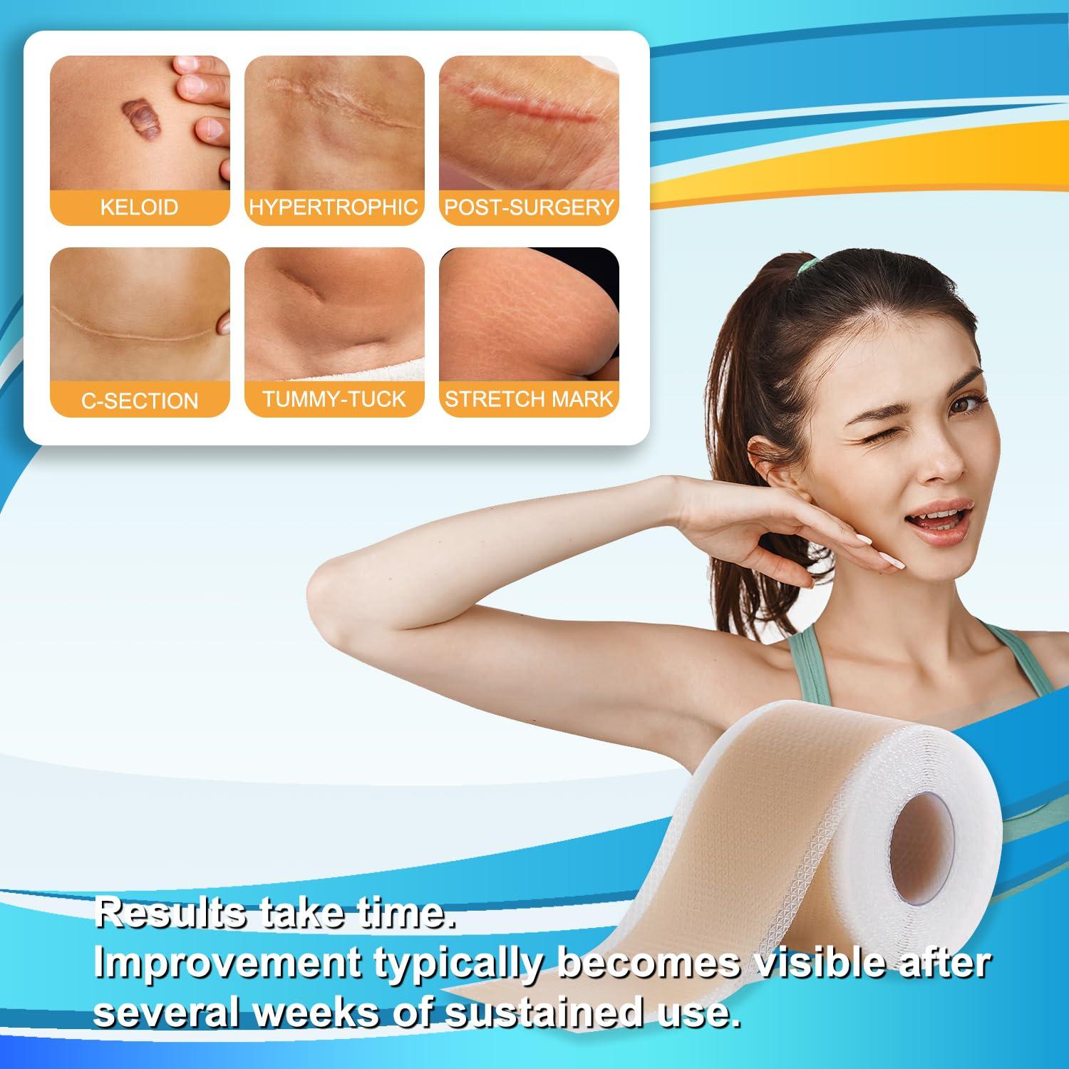 Hysimedy Medical Grade Silicone Scar Tape for Surgical Scars (1.6\" x 120\" - 3M) Professional Silicone Scar Sheets Scar Treatment for Face Wrinkles, C Section Recovery, Keloid Bump Removal Silicone Scar Patches