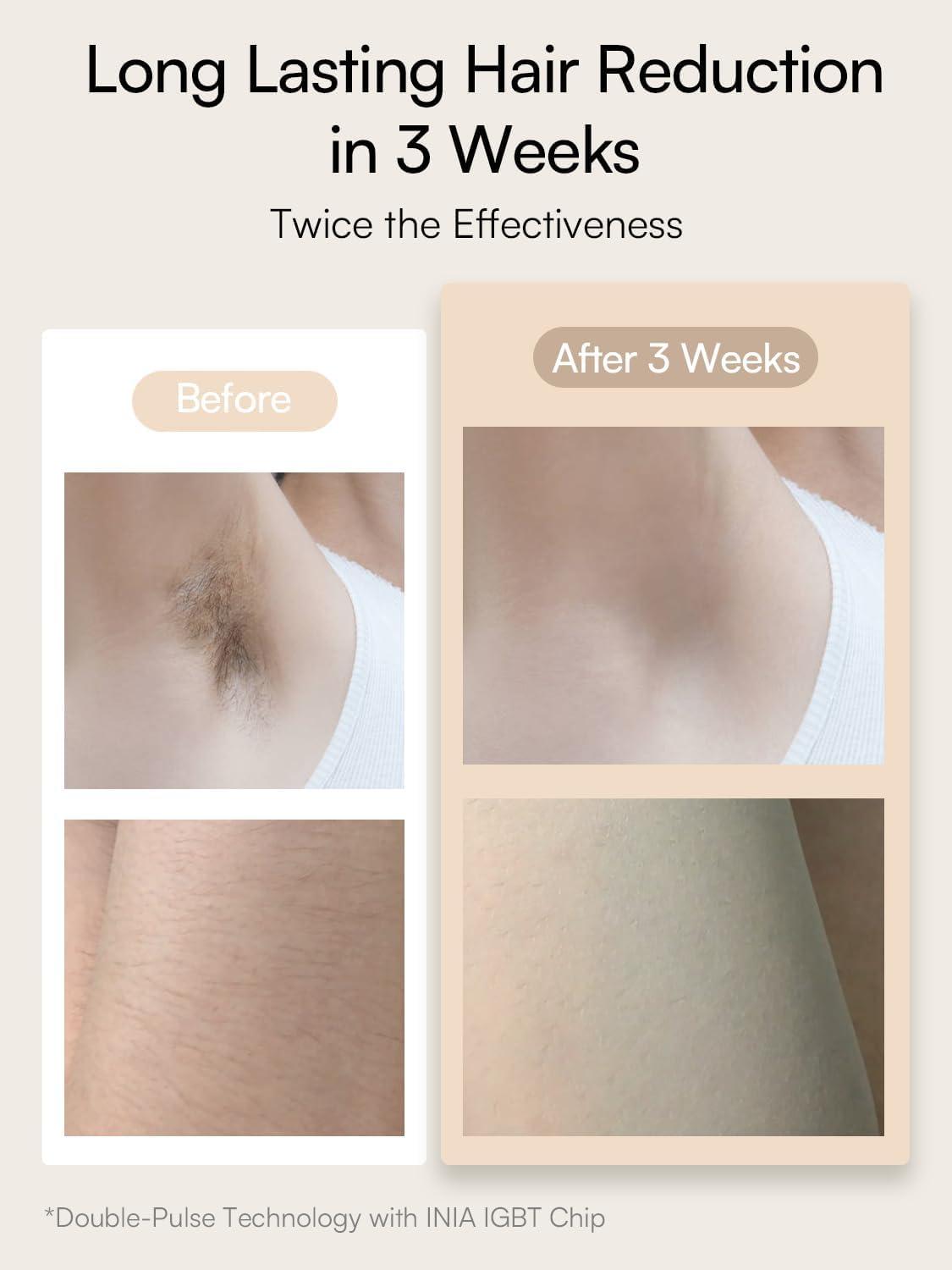 INIA INIA Laser Hair Removal for Women and Men, IPL Hair Removal Device with Sapphire Ice-cooling, Double Effectiveness & 5 Flashes per Second for Long-lasting and Nearly Painless Results