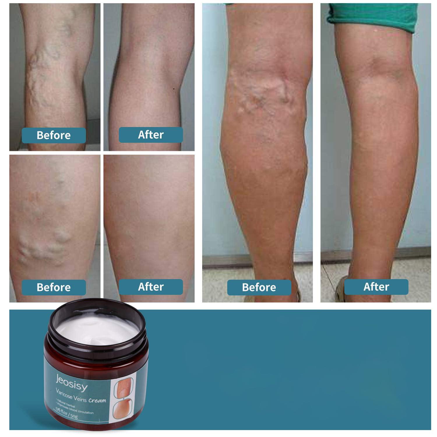 jeosisy jeosisy Varicose Vein Cream for Legs - Varicose Veins Cream, Varicose & Spider Veins Soothing Leg Cream for Women Men