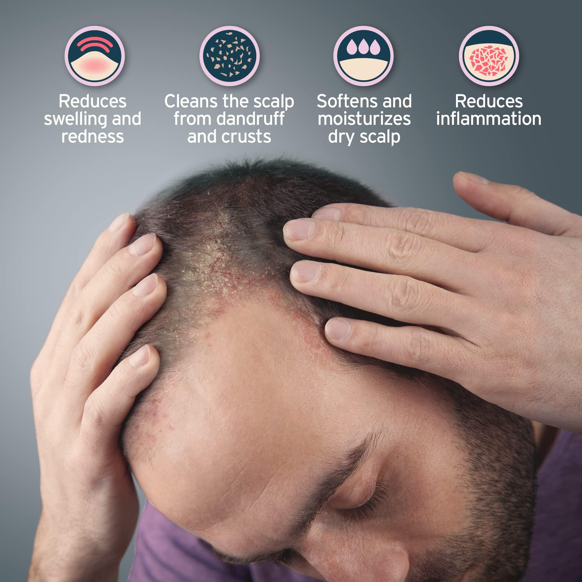 Sphagnum Botanicals Sphagnum Botanicals Severe Seborrheic Dermatitis Treatment with Shampoo and Serum - Salicylic Acid with Peat Mud for a Clear and Itch-Free Scalp