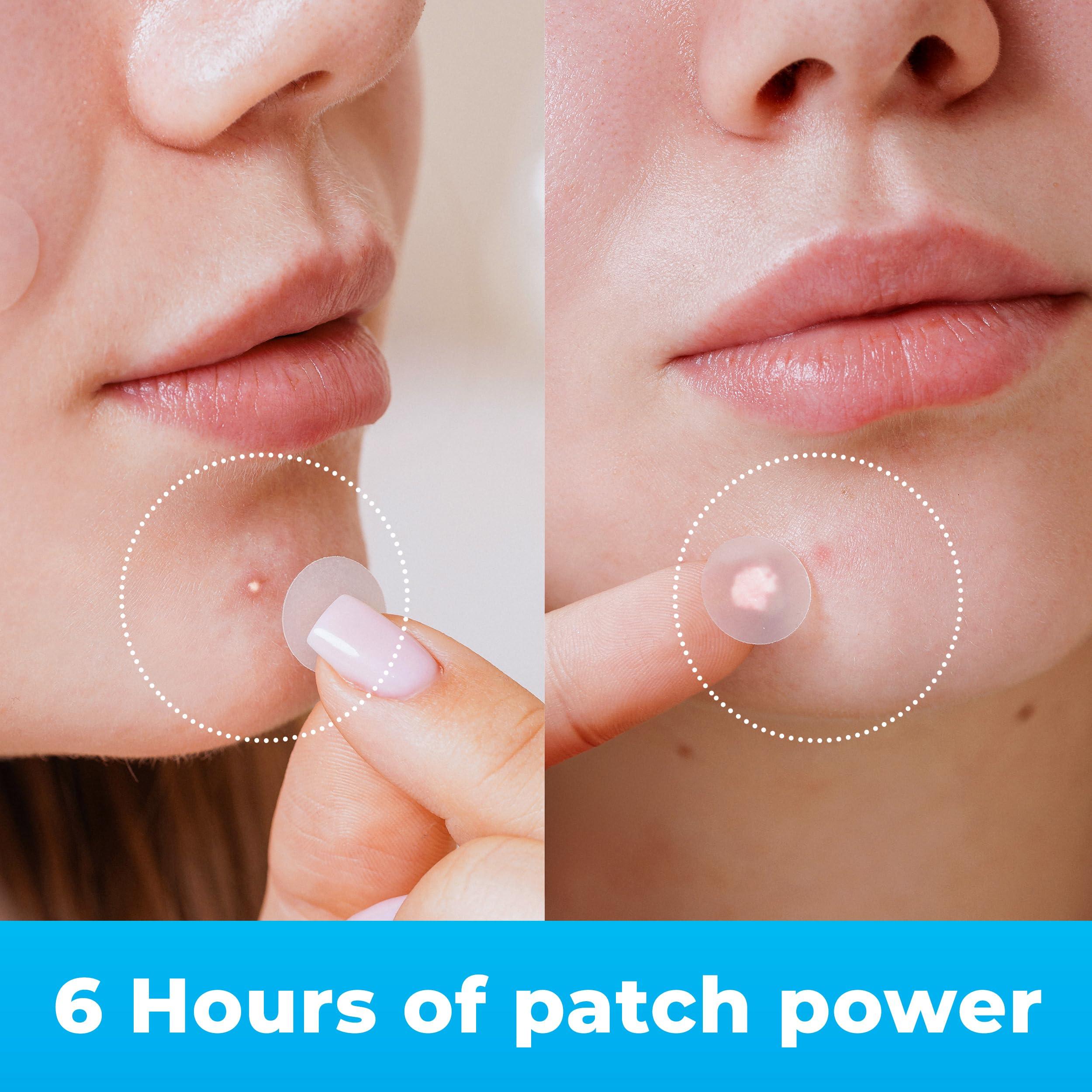 KEYCONCEPTS PatchRx Pimple Patches for Face (120 Patches), Hydrocolloid Acne Patches with Tea Tree Oil, Pimple Patch Pimple Stickers - Hydrocolloid Patch Acne Dots - Acne Pimple Patches For Face - Zit Patches