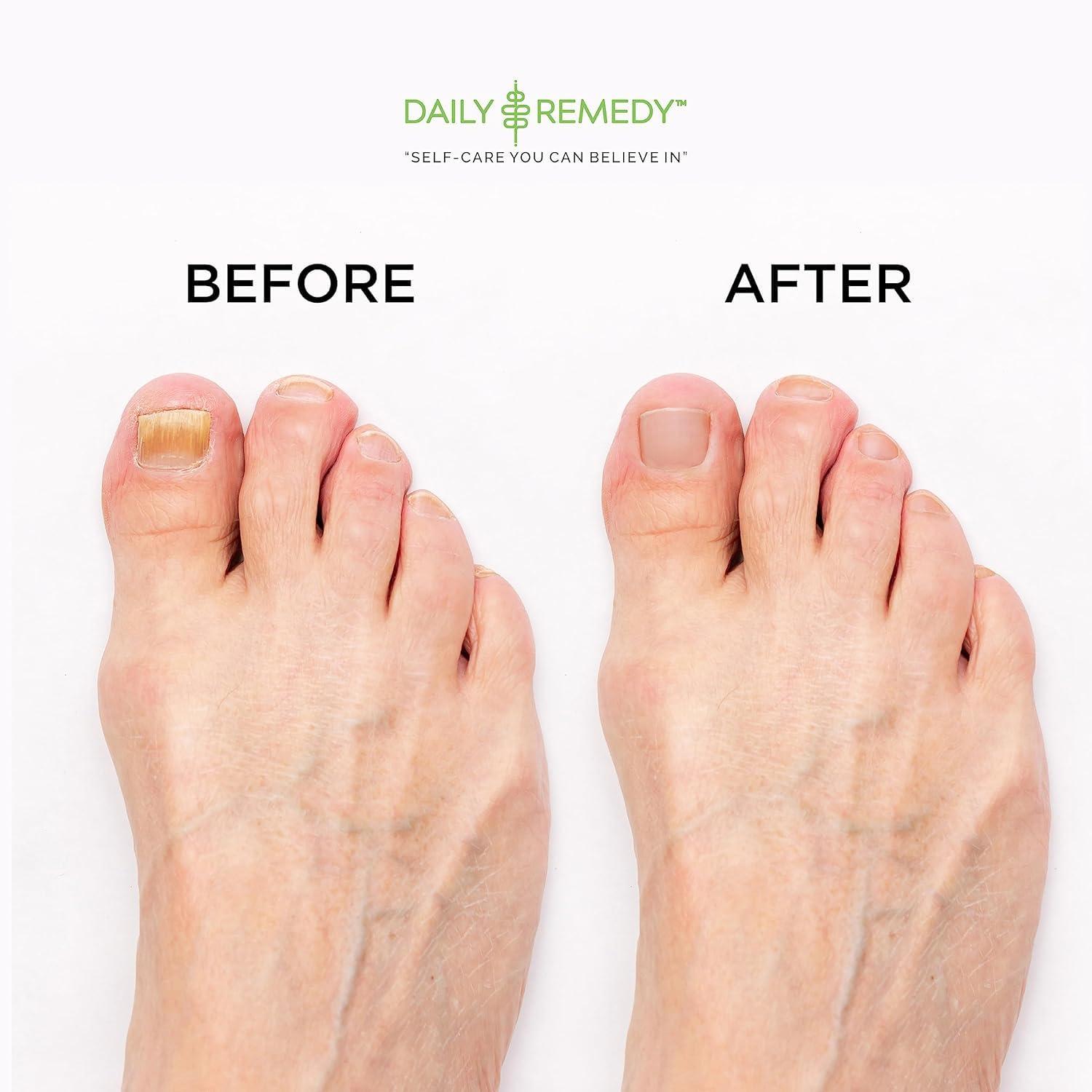 DAILY REMEDY EXTRA STRENGTH Tea Tree Oil Foot Soak with Epsom Salt - Made in USA - for Toenails, Athlete\'s Foot, Itchy Feet, Stubborn Smelly Foot Odor, Pedicure, Foot Calluses & Soothes Sore Tired Achy Feet-2 Pack