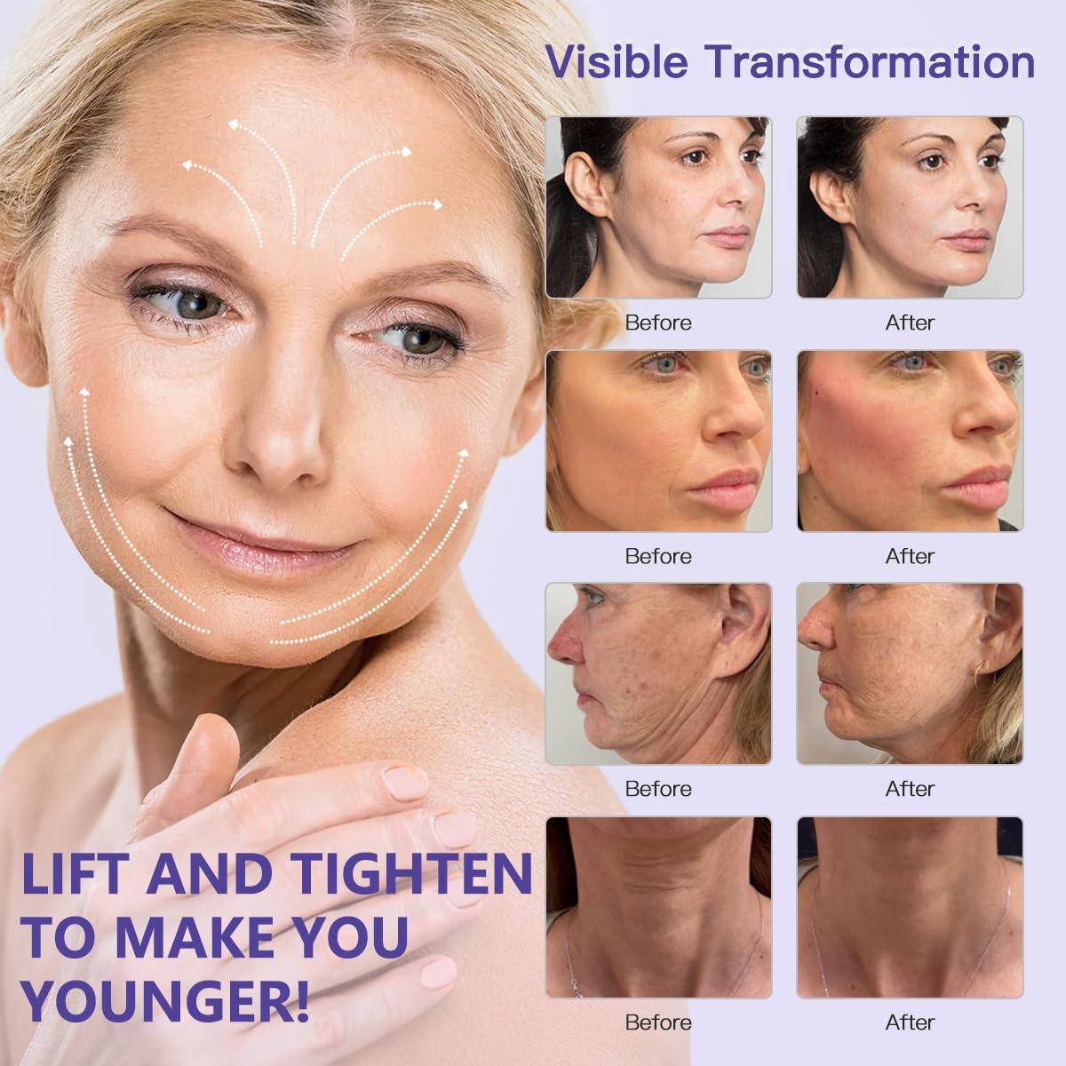 Aoru thored Pdo Cog Thread For Face Lift/Whole Body Lifts Molding Cog Thread/Pdo Cog Thread 100mm Sharp(Molding sharp 19G 100MM) (20pieces)