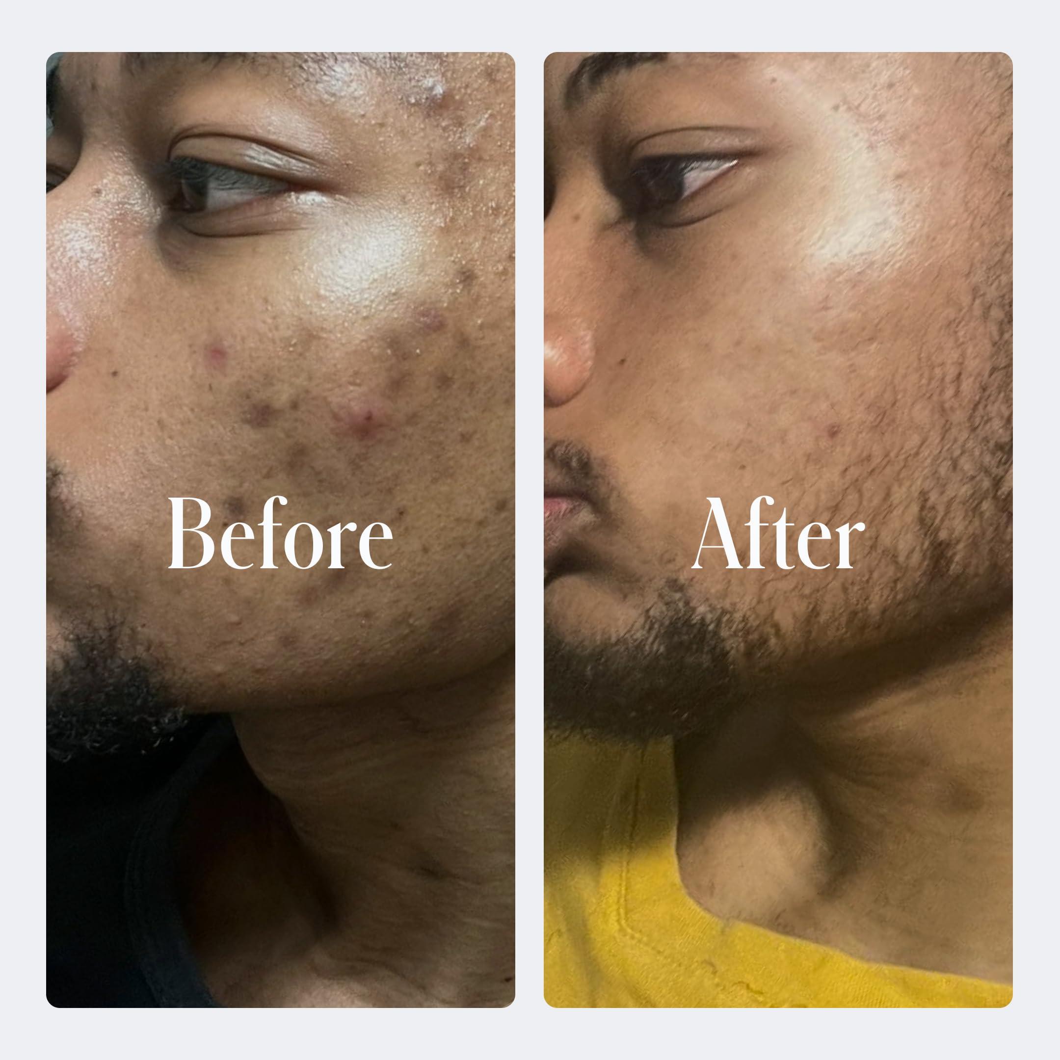 Geologie Geologie Complete Skincare Set for Men & Women | 1-Month Simple & Effective Daily Clear Skin Routine | Acne, Oily Skin, Dark Spots | Face Wash 2-Pack, Retinol Face Cream, SPF15 Moisturizer & Eye Cream