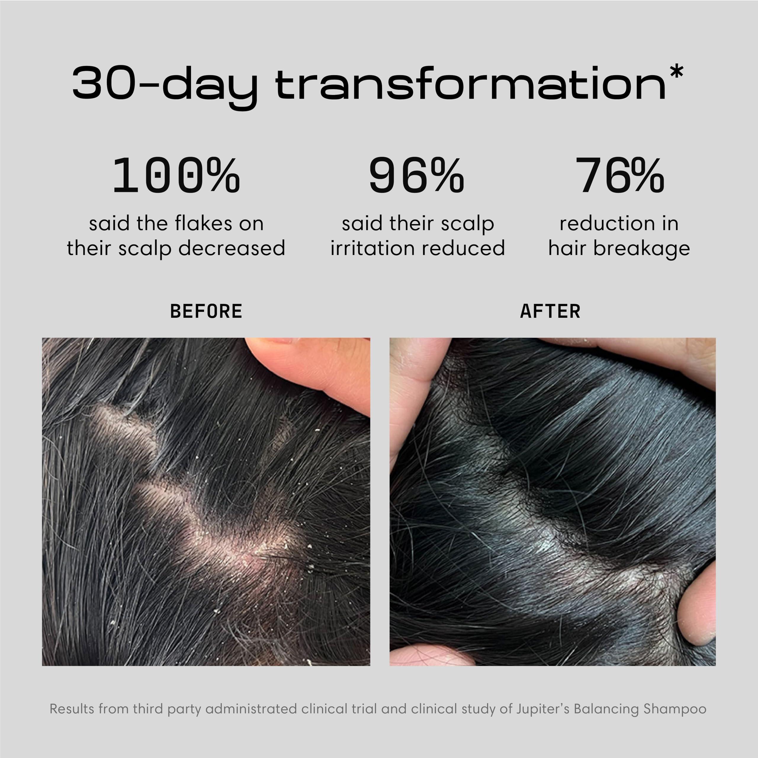 Jupiter Jupiter, Physician-Formulated Anti-Dandruff Shampoo & Conditioner, for Flaky, Itchy, Oily, Dry Scalp, Vegan, Sulfate-Free, Color-Safe, & Paraben-Free, Dry Scalp Shampoo and Conditioner for Women & Men