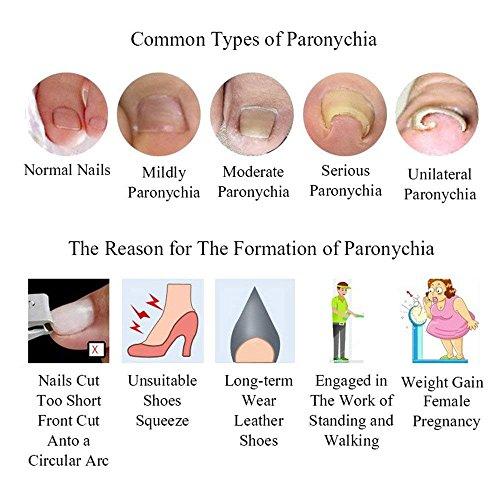 Gnker Ingrown Toenail Pedicure Tool Straightening Clip Curved BS Brace for Toenails Toe nail (Tool Kit)