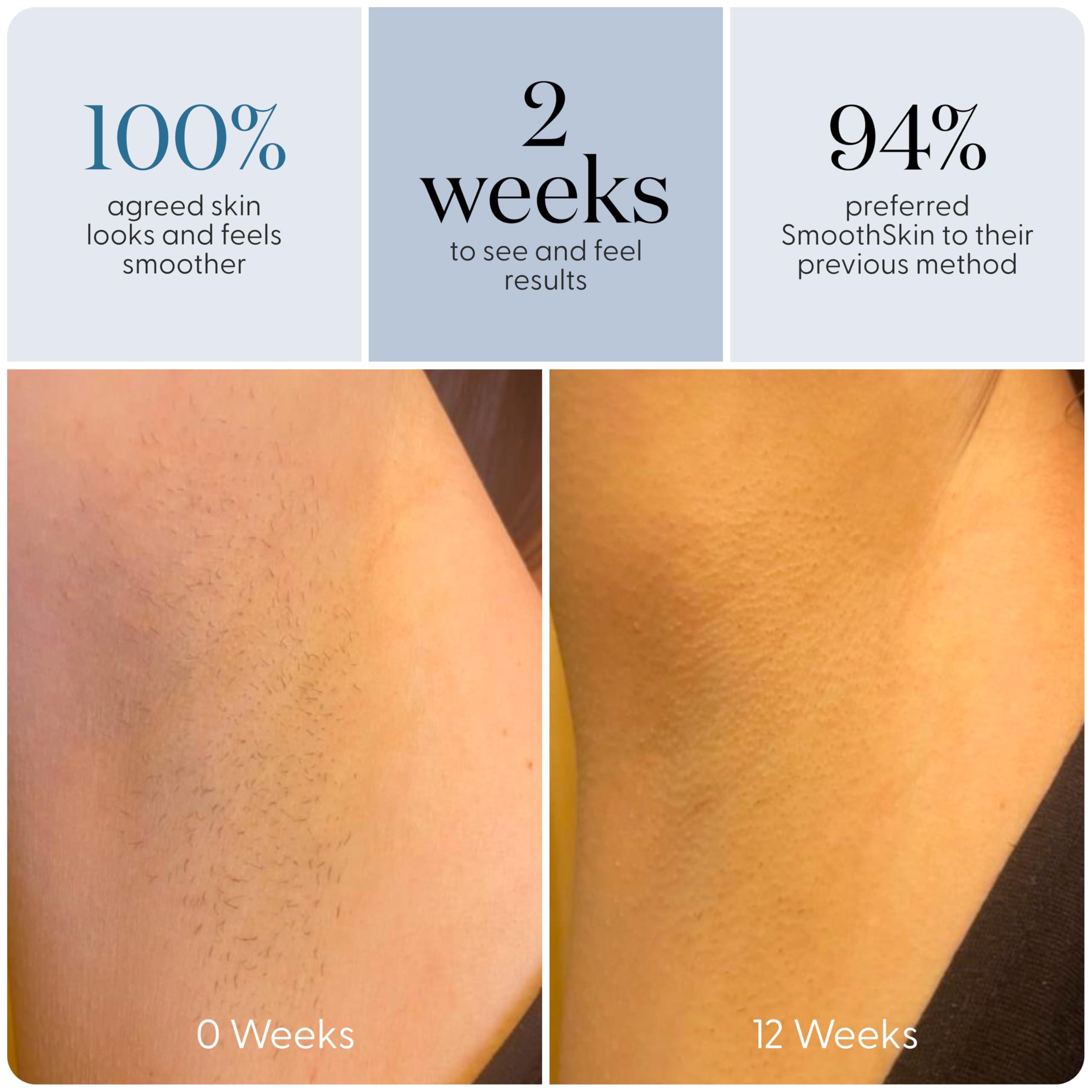 SMOOTHSKIN SmoothSkin Pure Adapt Green IPL Laser Hair Removal Device for Women & Men, Pure Fit Upgrade; Long-Lasting Hair Reduction, for Body & Face, Home Hair Removal, Alternative to Laser & Bikini Shaver