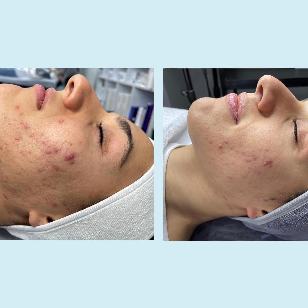 Perfect Image Salicylic Gel Chemical Peel - Enhanced with Green Tea Extract and Tea Tree Oil (20% Strength)