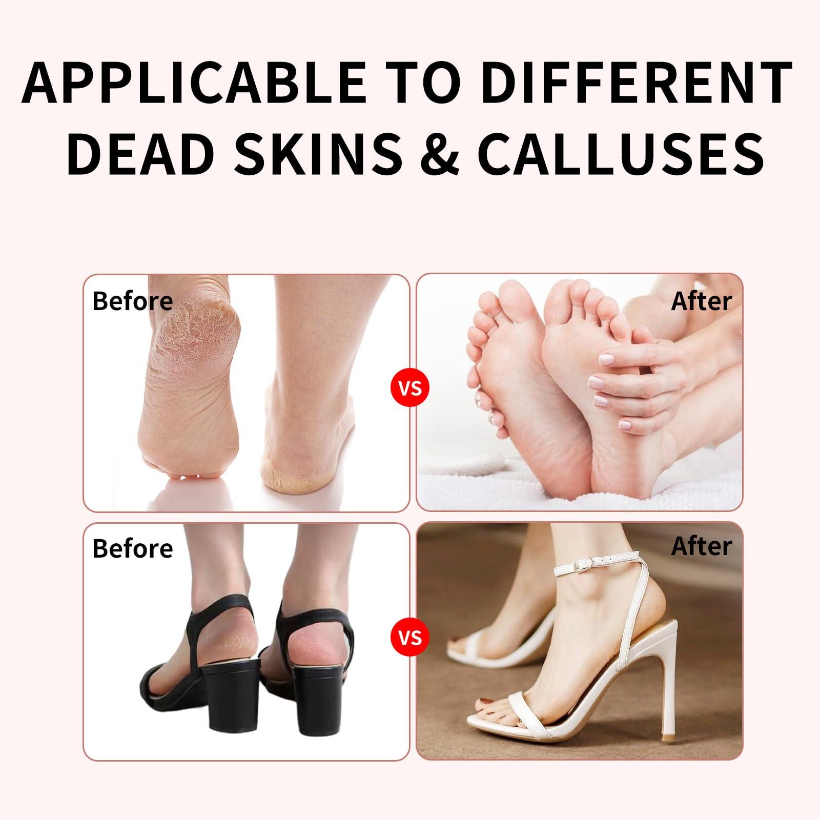 Turoco 2025 Upgraded Electric Foot Callus Remover, Best Callus Remover for Feet & Electric Foot File, Foot Scrubber for Dead Skin, Professional Pedicure Tools for Feet with 60 Sandpaper Discs