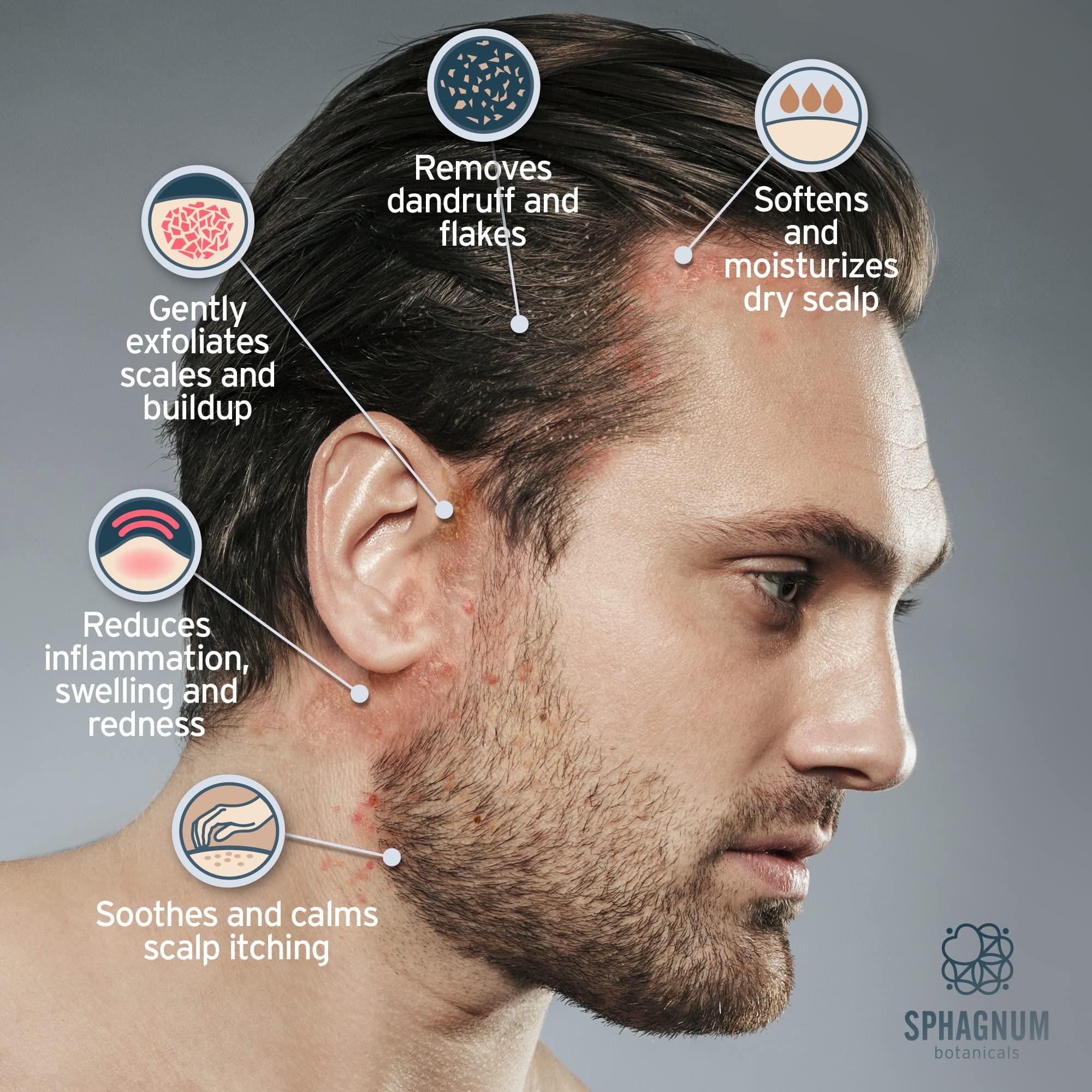 Sphagnum Botanicals Sphagnum Botanicals Severe Seborrheic Dermatitis Treatment with Shampoo and Serum - Salicylic Acid with Peat Mud for a Clear and Itch-Free Scalp