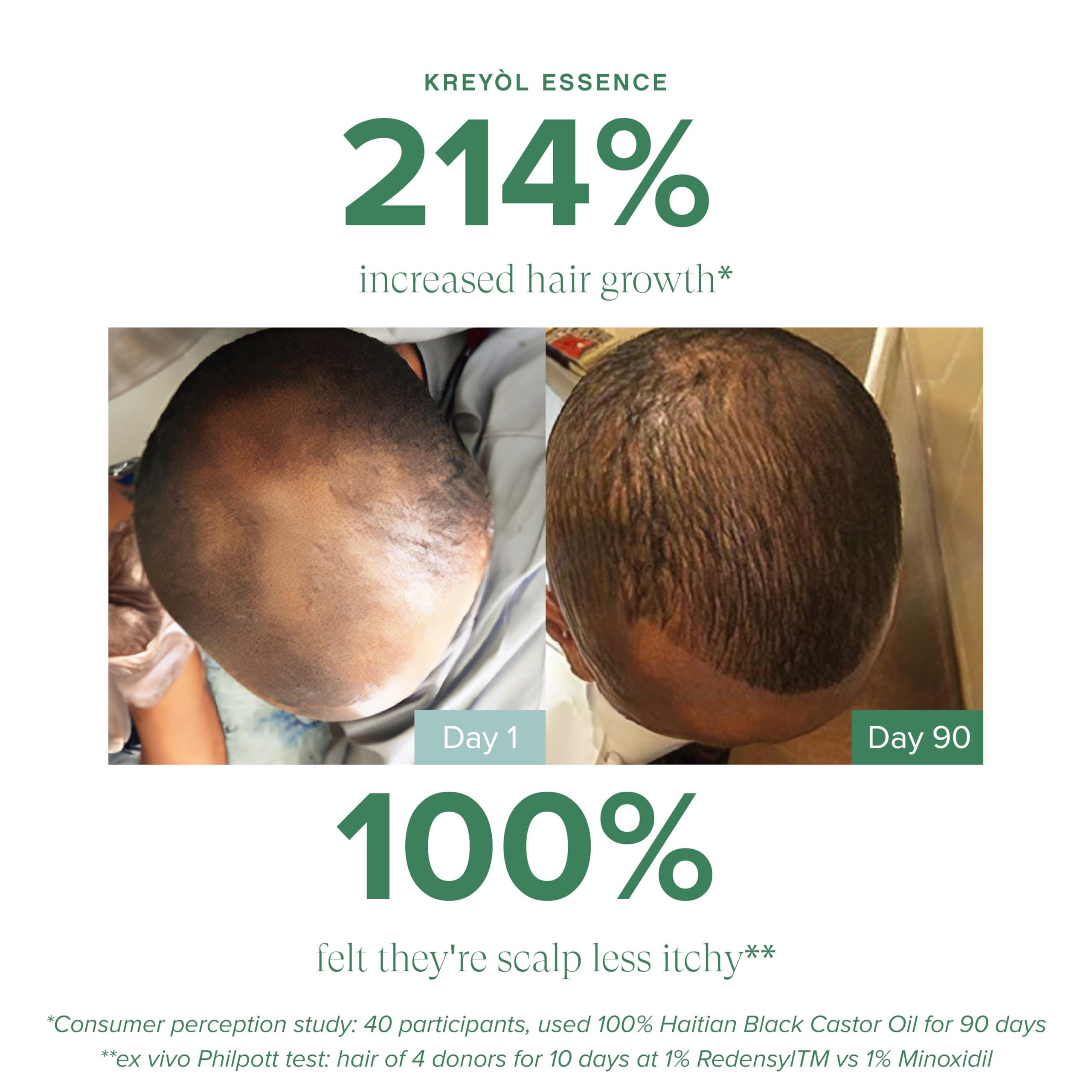 KREYL ESSENCE Kreyol Essence - Save Our Scalp Serum (S.O.S Serum) - Redensyl + Haitian Black Castor oil, Fuller Looking Hair, Cold Pressed Castor Oil, Natural Ingredients 1.7 oz