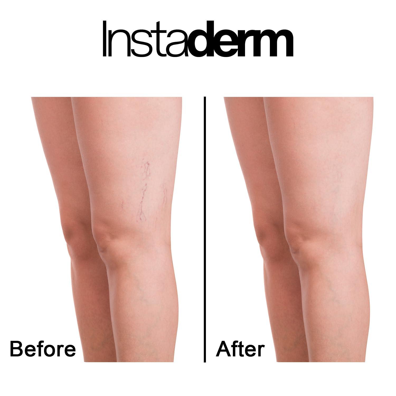Instaderm Instaderm Vitamin K Cream- Bruise Healing Formula with Arnica. Dark Spot Moisturizer for Bruising, Spider Veins & Broken Capillaries. Repair Under Eye Dark Circles, & Puffiness.