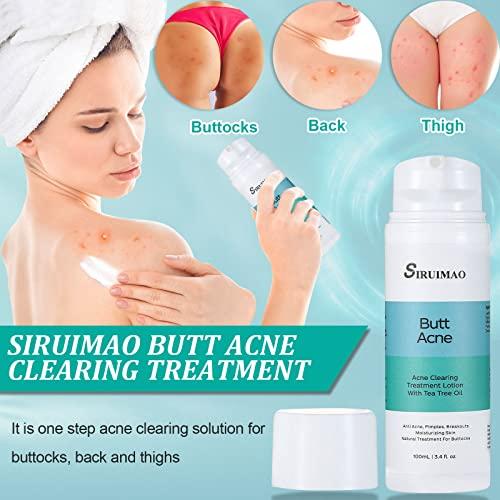 SIRUIMAO SIRUIMAO Butt Acne Clearing Treatment (3.5OZ), Bum Acne Treatment for Clearing Acne, Pimples, Blackheads, Zits and Razor Bumps for the Buttocks and Thigh Area (2 bottles)