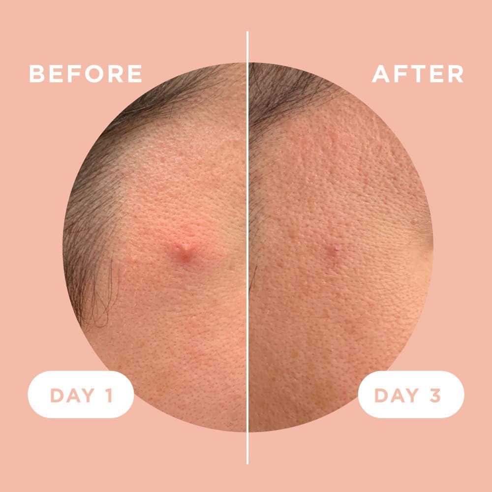 ZitSticka ZitSticka Killa Acne Patches for Face - World\'s Most Potent Pimple Patch with Fast-Acting Microdarts - Starts Working within 2 Hours for Deep, Early-Stage Zits & Blemish - 4 Count