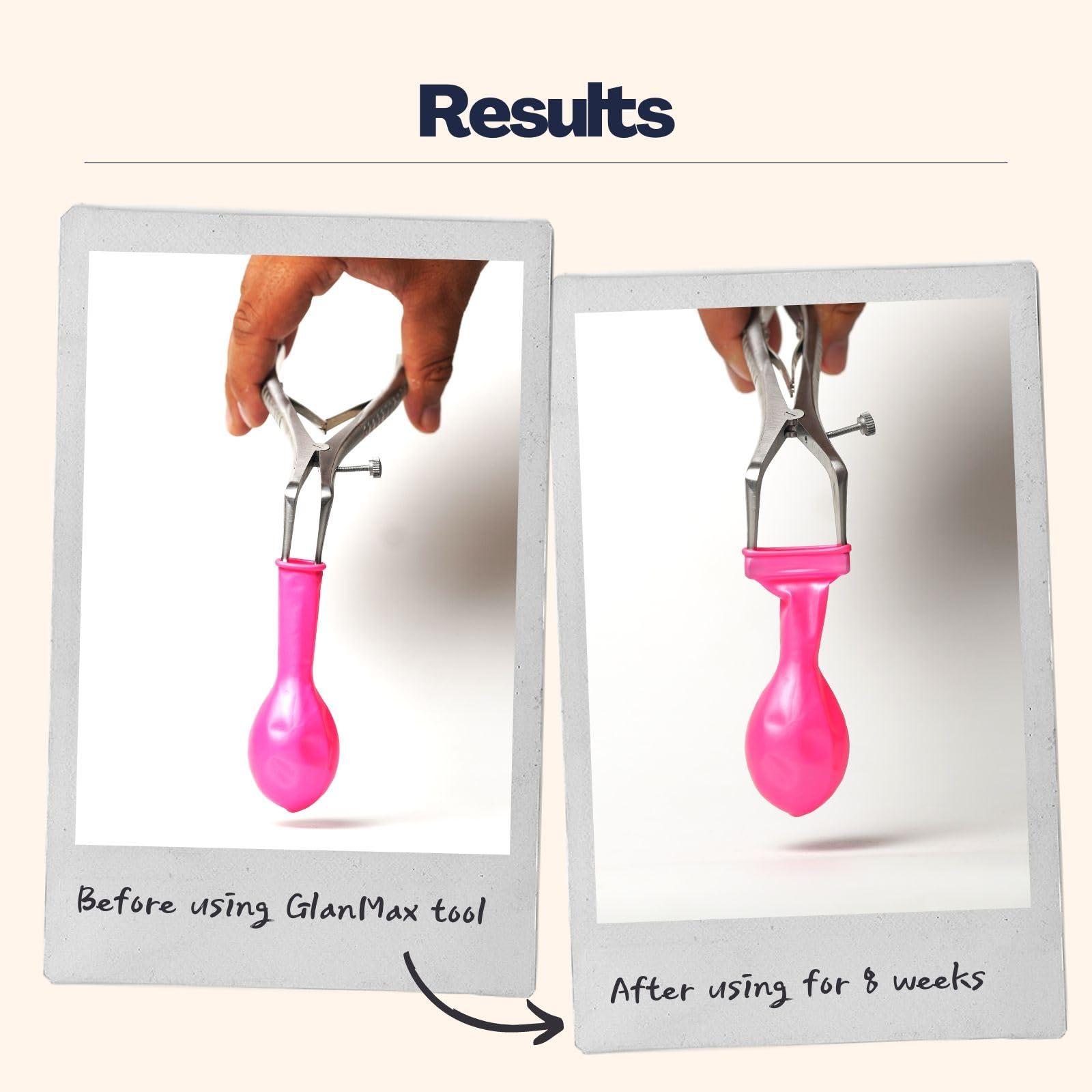 Cause Human GlanMax tool for phimosis | Phimosis Stretching tool | Opens upto 24mm | Safe & very quick results