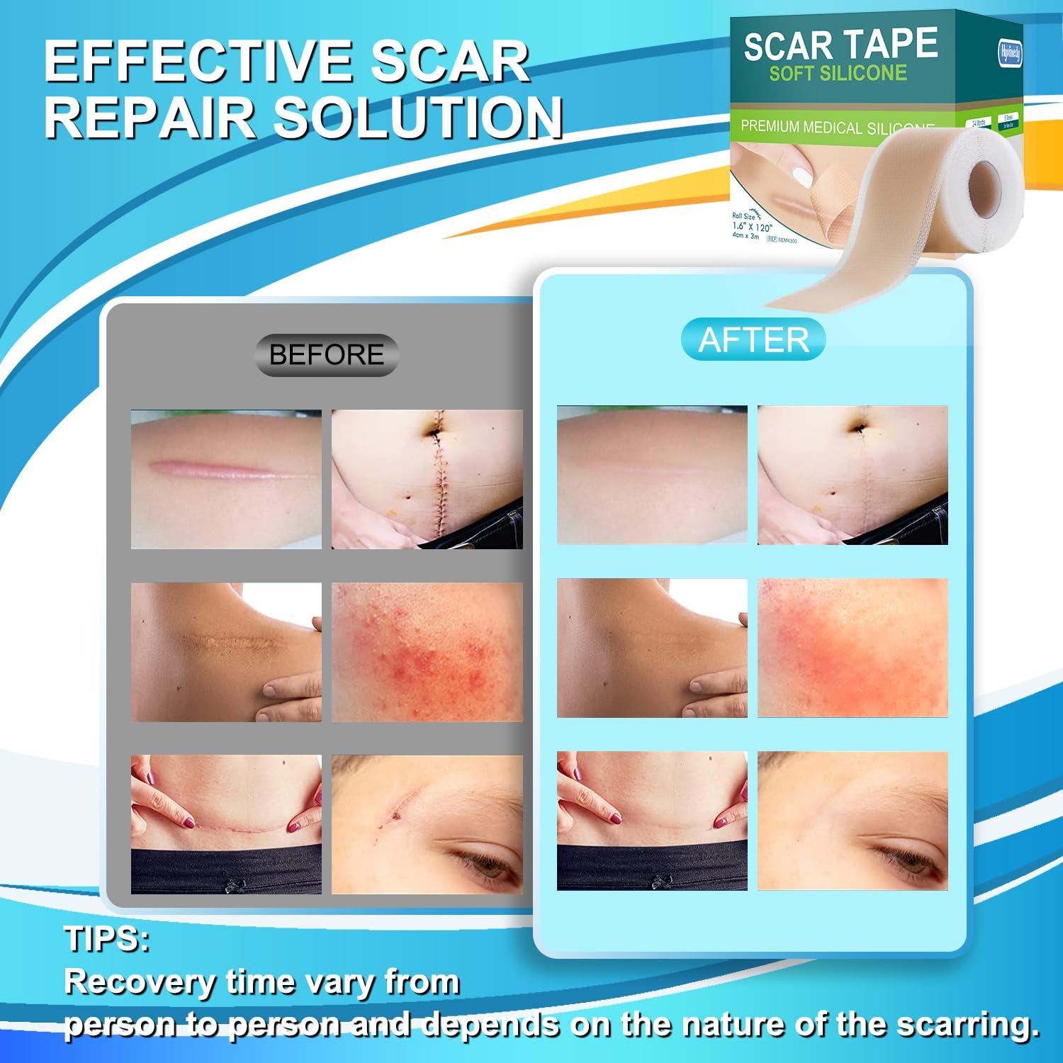 Hysimedy Medical Grade Silicone Scar Tape for Surgical Scars (1.6\" x 120\" - 3M) Professional Silicone Scar Sheets Scar Treatment for Face Wrinkles, C Section Recovery, Keloid Bump Removal Silicone Scar Patches