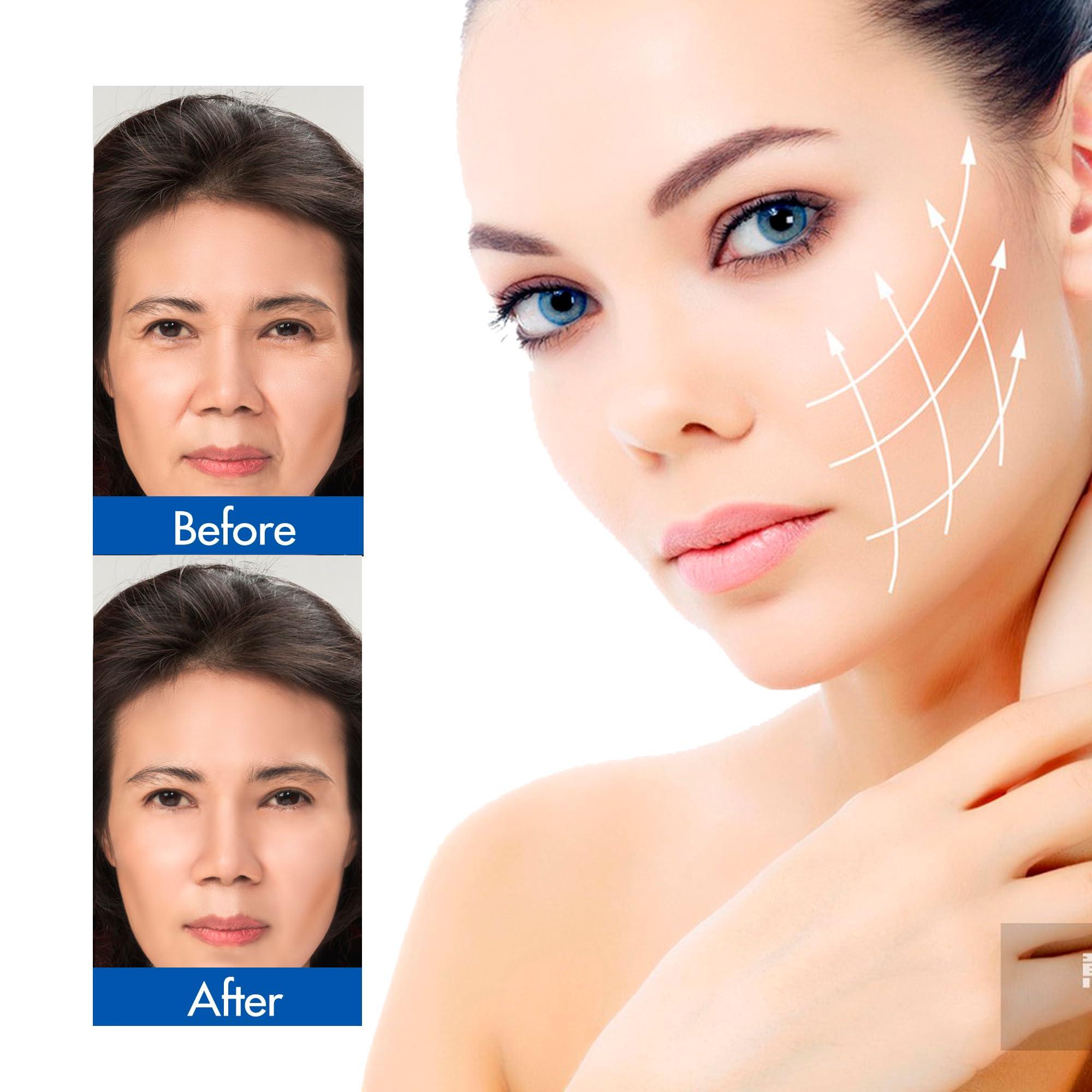 ESTEVO ESTEVO PDO Multi-Thread L-Type Blunt, Multiple PDO Mono Line Threads for Facial Filling (16PCS-23G*38mm)