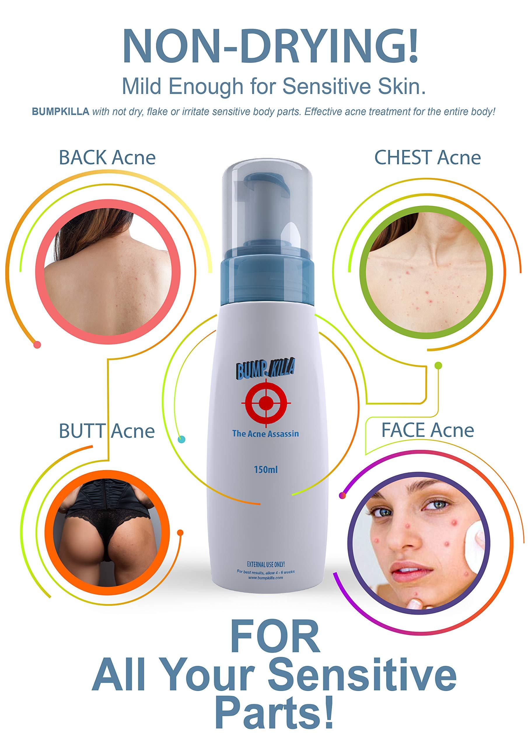 BumpKilla BumpKilla Acne Treatment For Sensitive Skin - 80% of Acne Gone in 4 Weeks. (Double Bottle)