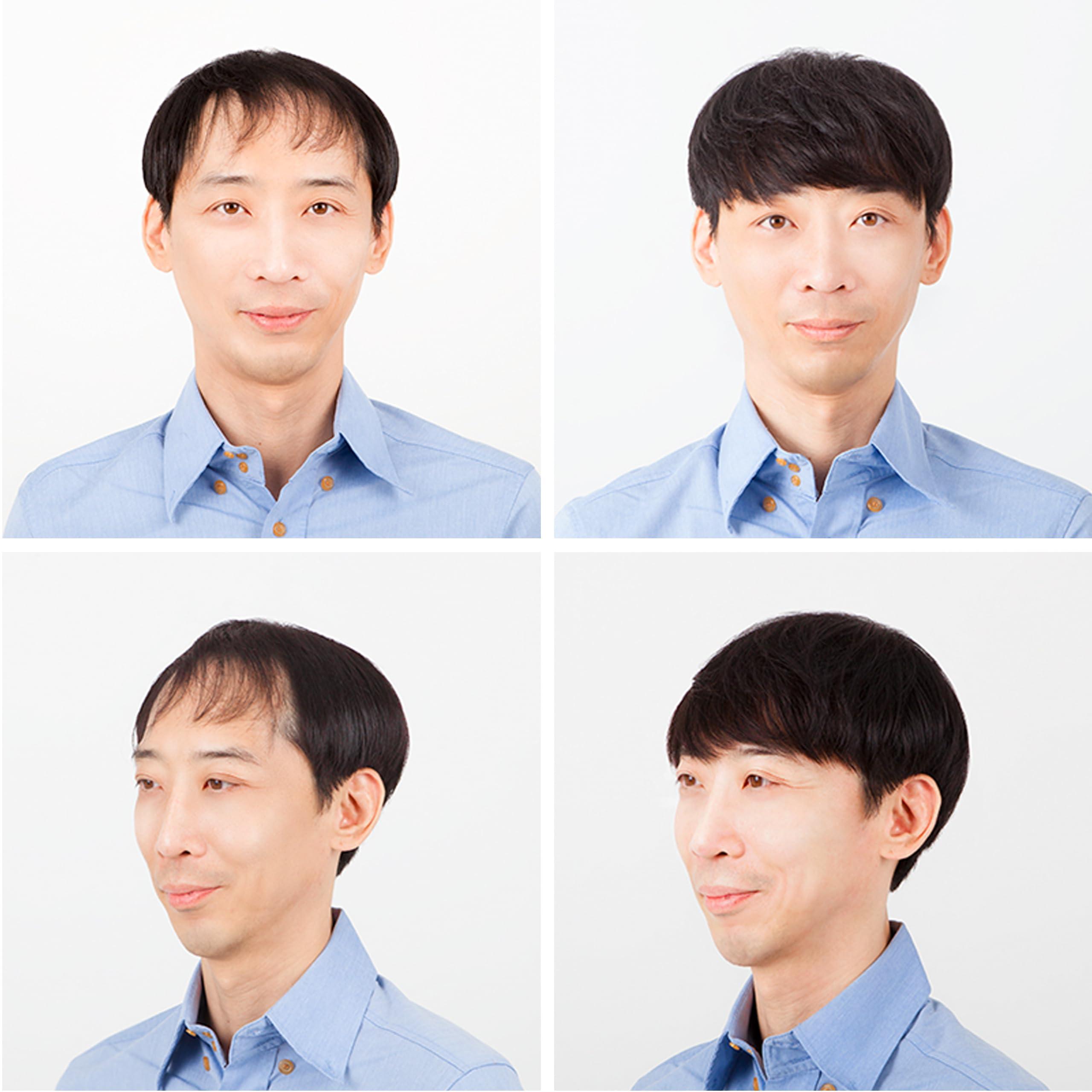 JY STORE Generic Men\'s 100% Human Hair Crown Partial Wig for Receding Hairline, M-Shaped Balding, and Alopecia Areata, Natural Black