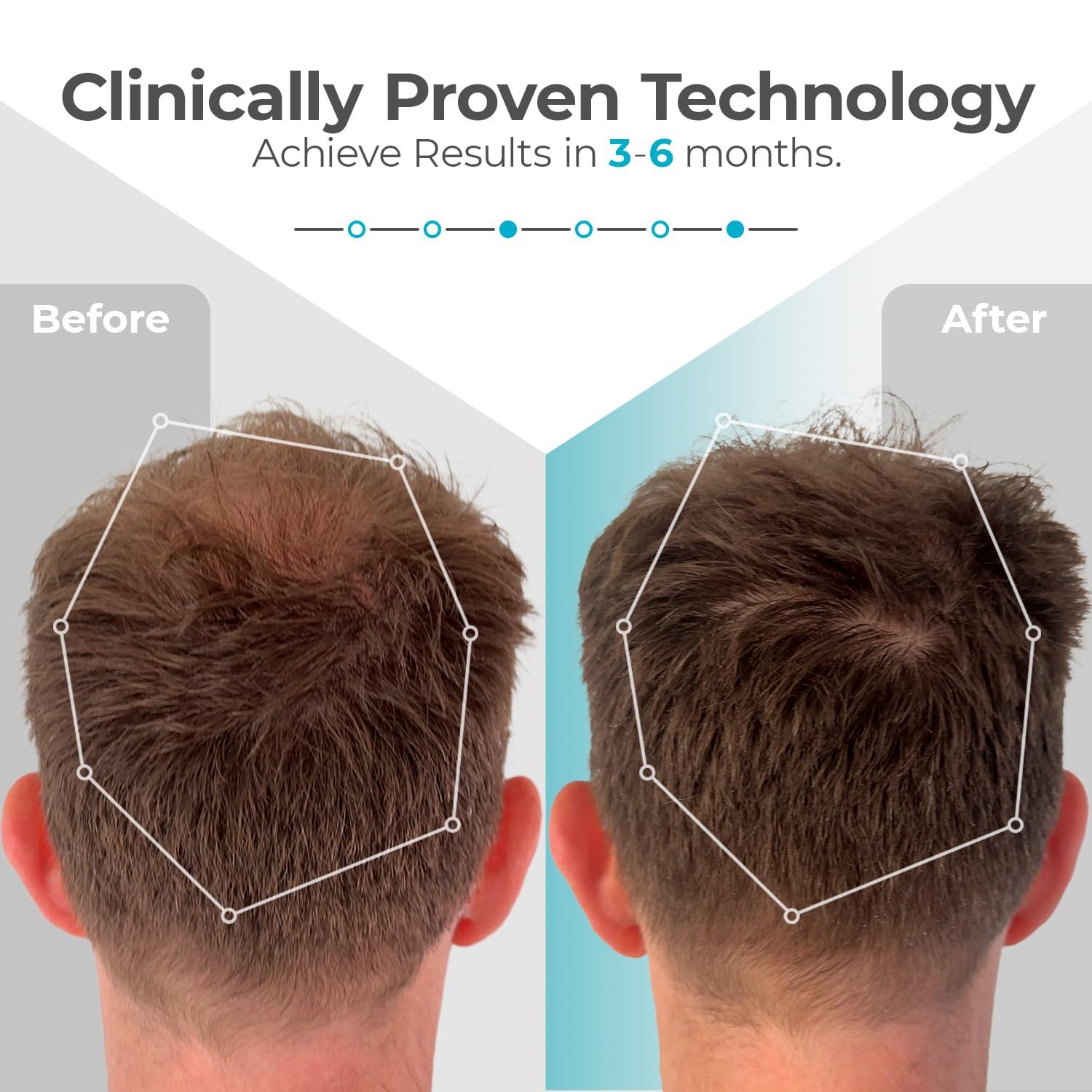 Capillus Capillus Plus S1 Mobile Laser Therapy Cap for Hair Regrowth, with 214 Red Light Lasers for Laser Hair Growth, Red Light Hair Growth Hat