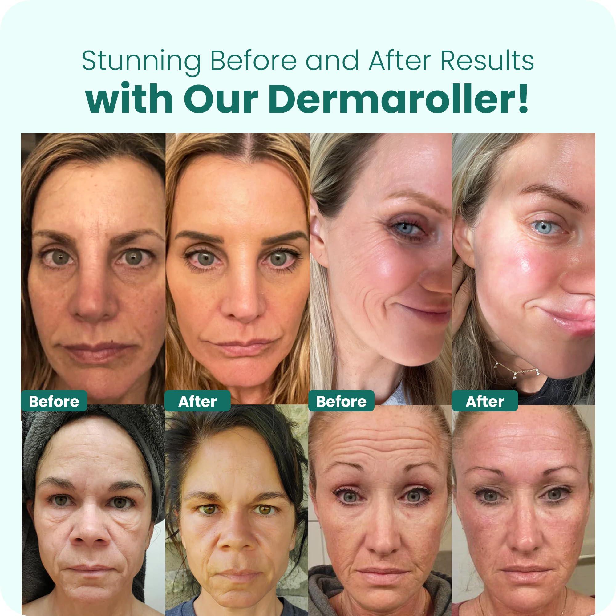 Gin Amber Gin Amber Dermaroller (0.25mm) - 192 Real Individual Needles, Microdermabrasion Device for Skin Care, Serum Absorption with Microneedling, Safe and Painless Revitalizer Tool, Hygienic Case