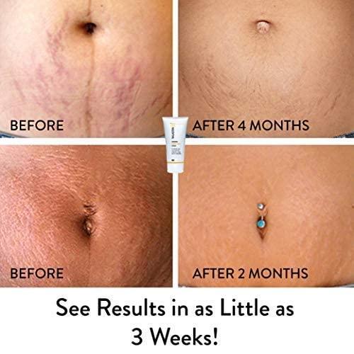TriLASTIN TriLASTIN-SR Intensive Stretch Mark Cream (3 count - 5.5 oz) Bundle with Hydro-Thermal Accelerator (2 count - 3 oz) | Fast-Acting Stretch Marks Remover | Hypoallergenic & Paraben-free