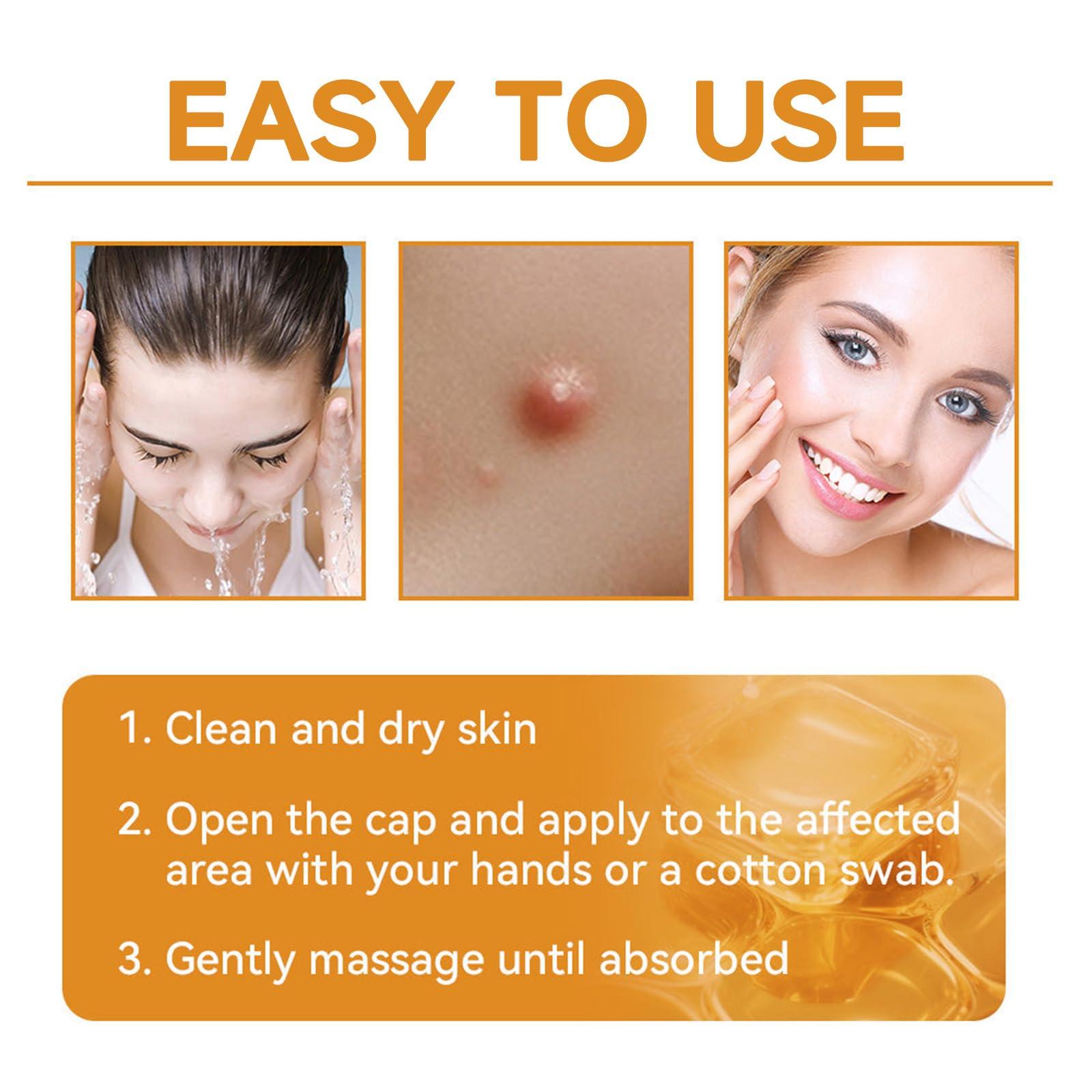 Zoencgz Bee Venom Removal Cream, New Bee Venom Treatment Cream, Professional Bee Venom Repair Cream for All Parts of The Body (4 Pack)