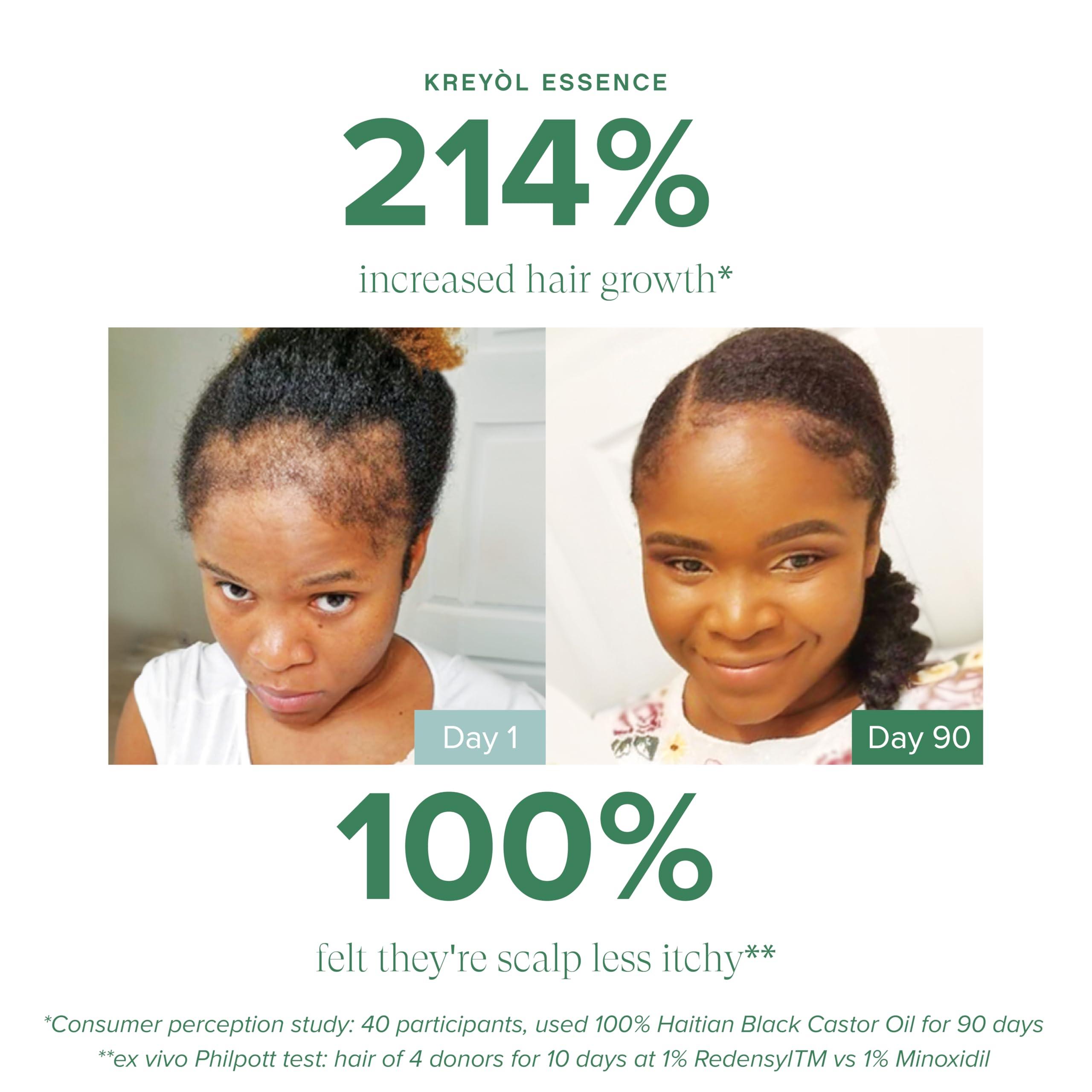 KREYL ESSENCE Kreyol Essence - Save Our Scalp Serum (S.O.S Serum) - Redensyl + Haitian Black Castor oil, Fuller Looking Hair, Cold Pressed Castor Oil, Natural Ingredients 1.7 oz