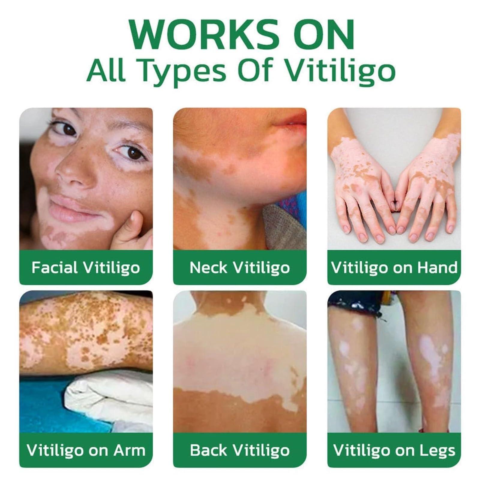 EXQST Vitiligo Fix Revitalize Elixir,2023 New Vitiligo Treatment Cream,Vitiligo Soothing Cream,Moisturizer Cream For Skin Vitiligo,Vitiligo Care Cream For Reduce White Spot