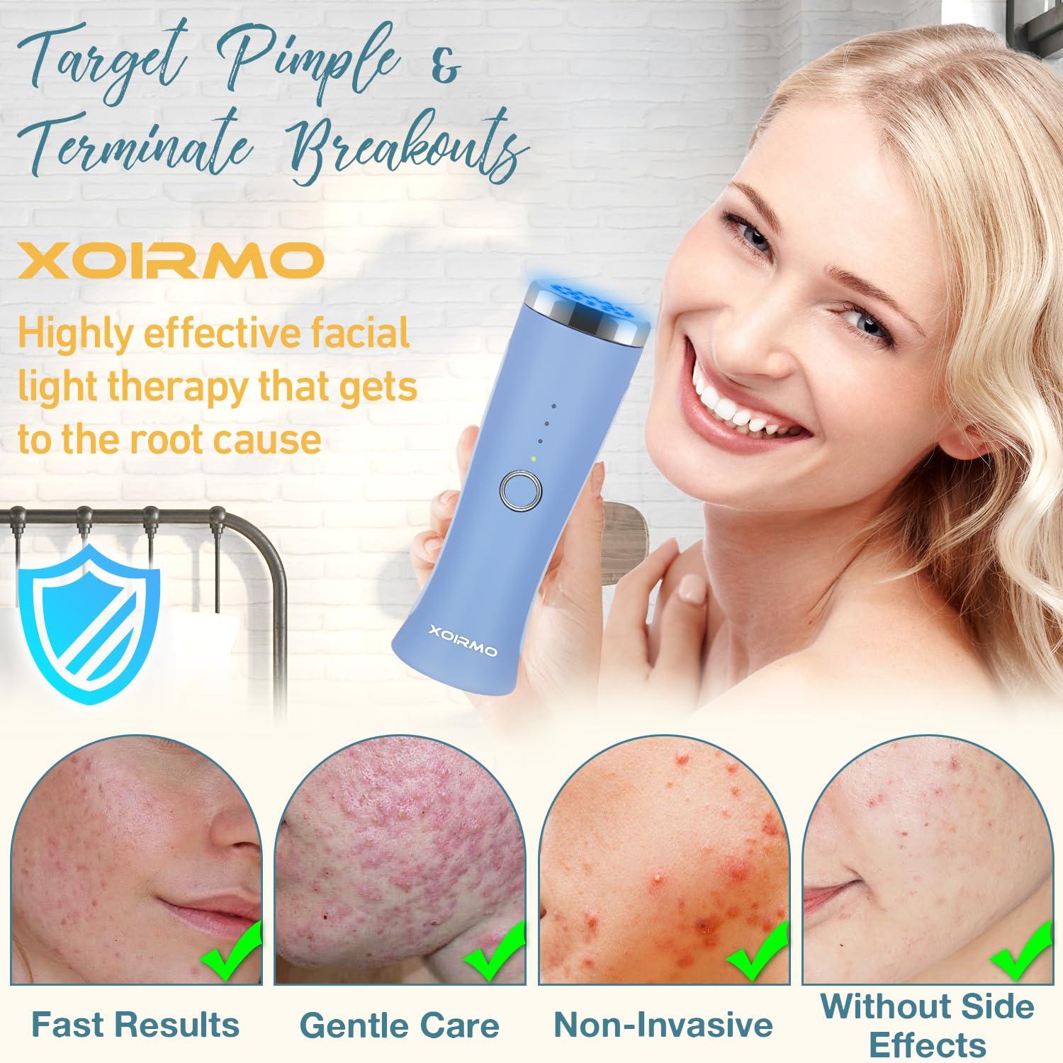XOIRMO Blue Light Therapy Device for Acne Spot Treatment - XOIRMO LED Acne Blue Light Therapy Wand for Face